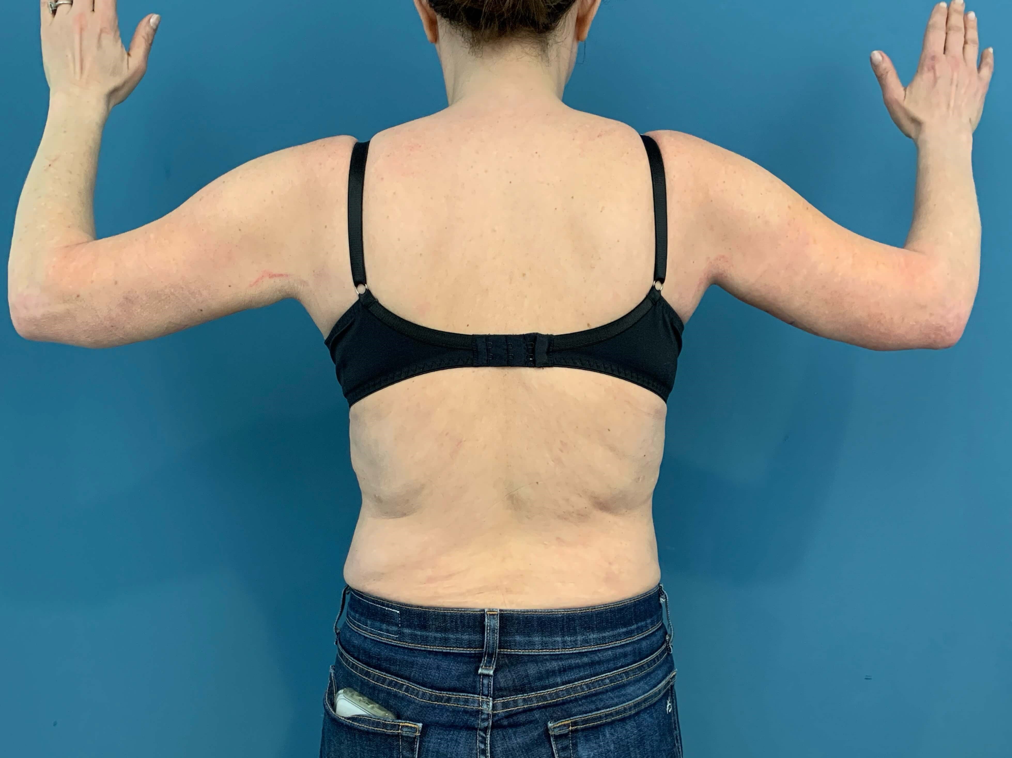 In Office Arm Lift (Brachioplasty)
