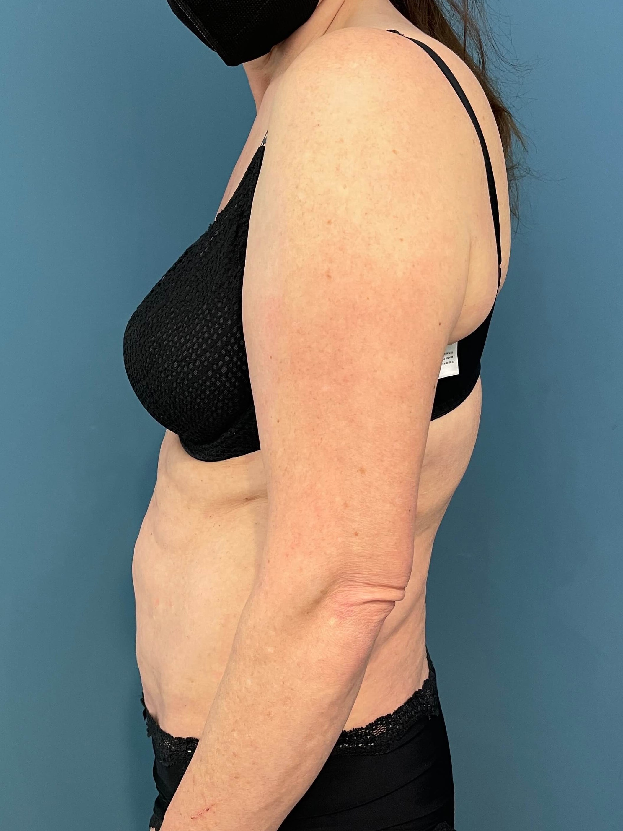 In Office Arm Lift (Brachioplasty) — before, view 2