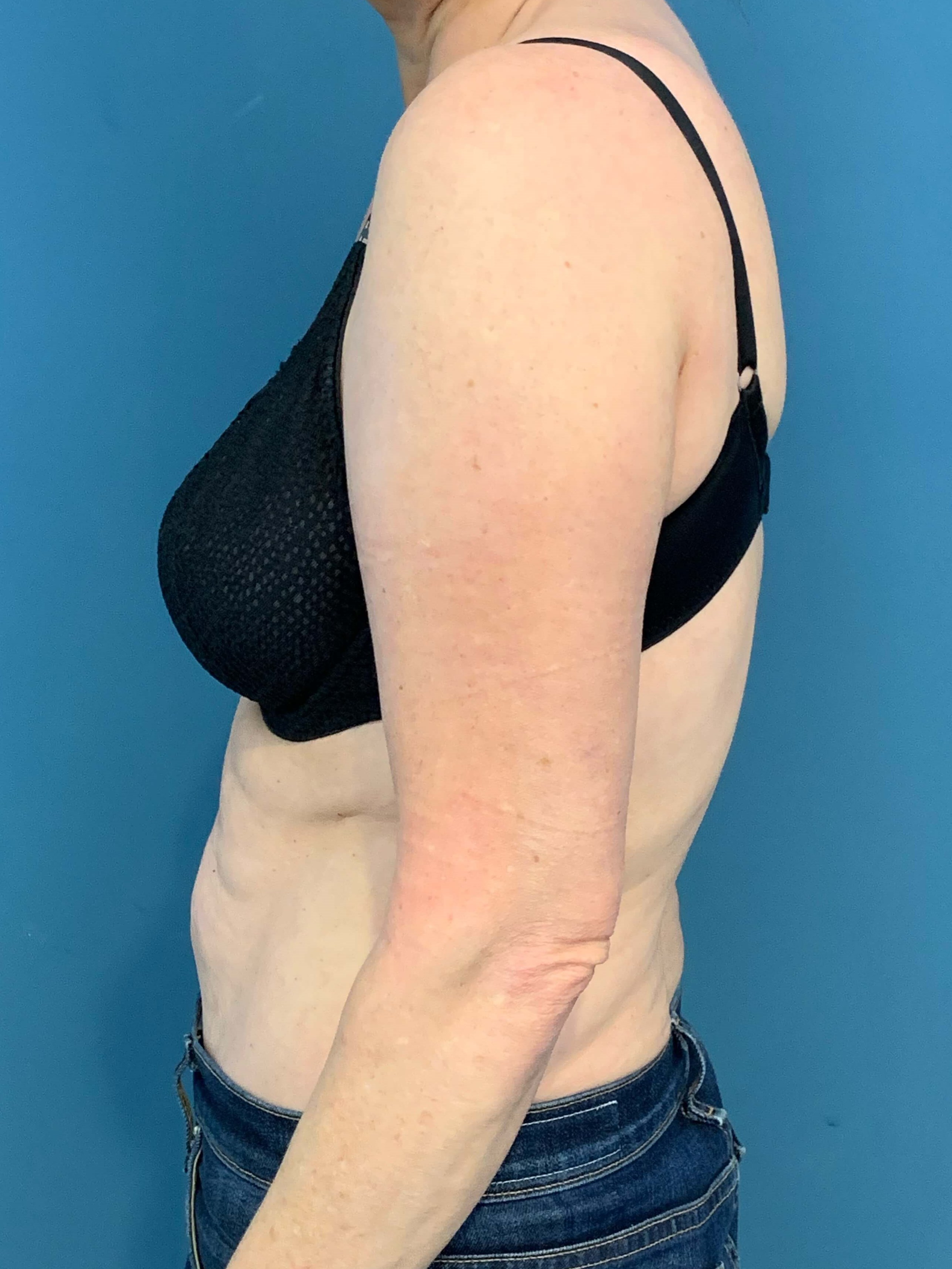 In Office Arm Lift (Brachioplasty) — after, view 2