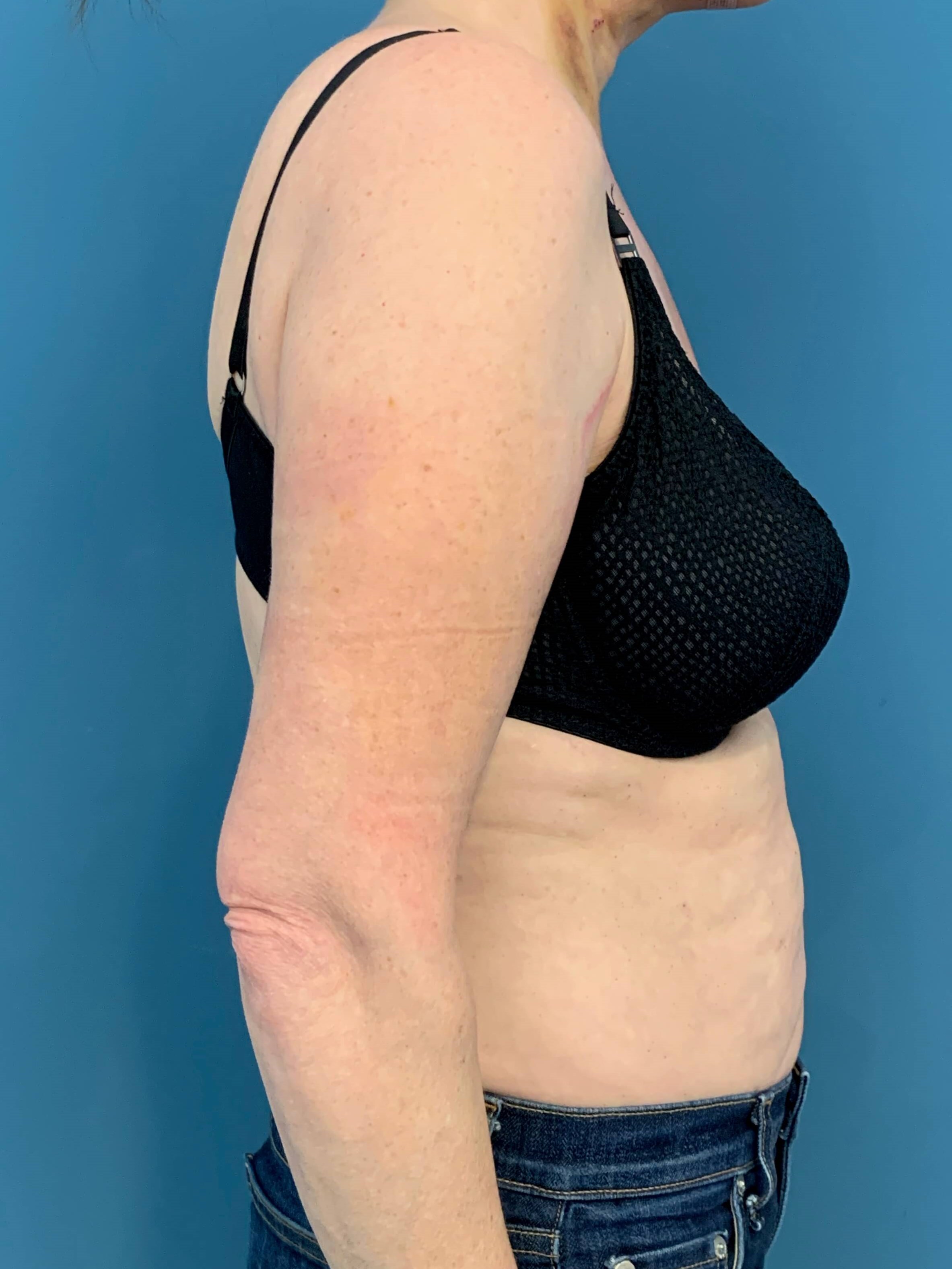 In Office Arm Lift (Brachioplasty) — after, view 3