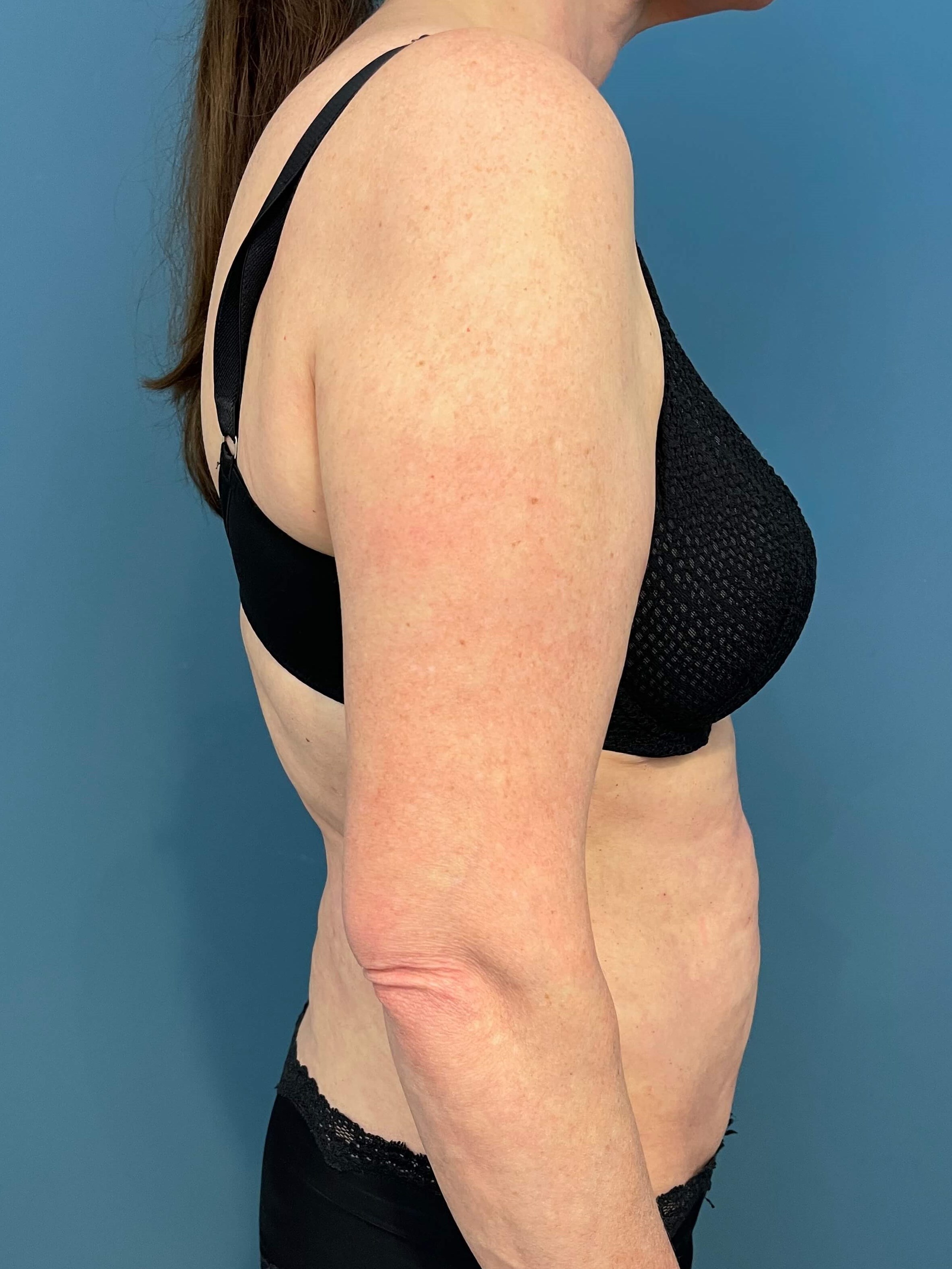 In Office Arm Lift (Brachioplasty) — before, view 3