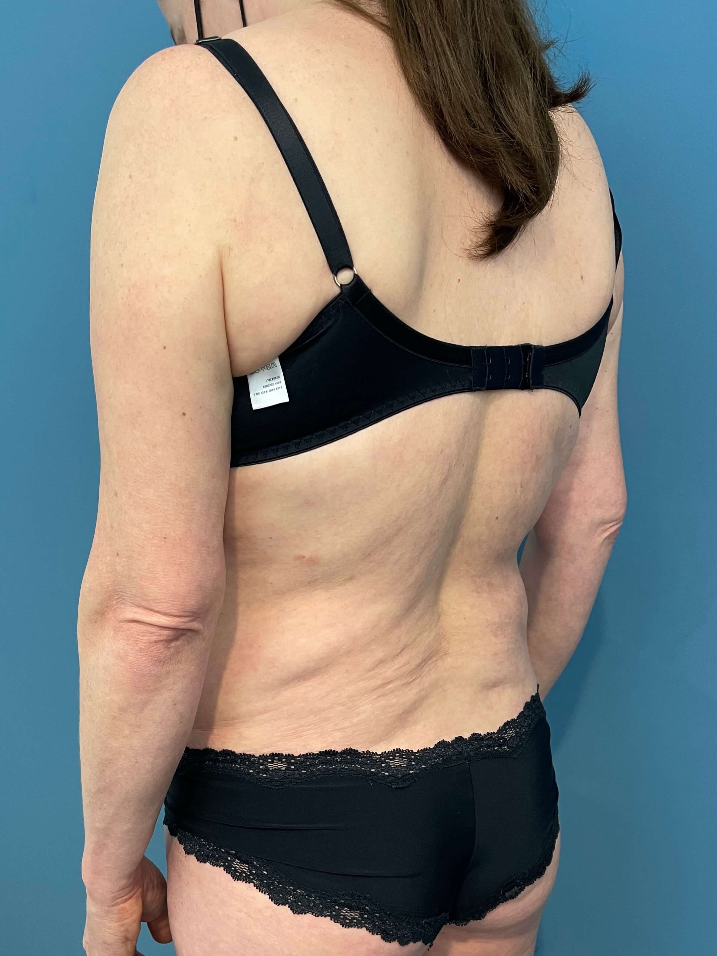 In Office Arm Lift (Brachioplasty) — before, view 4
