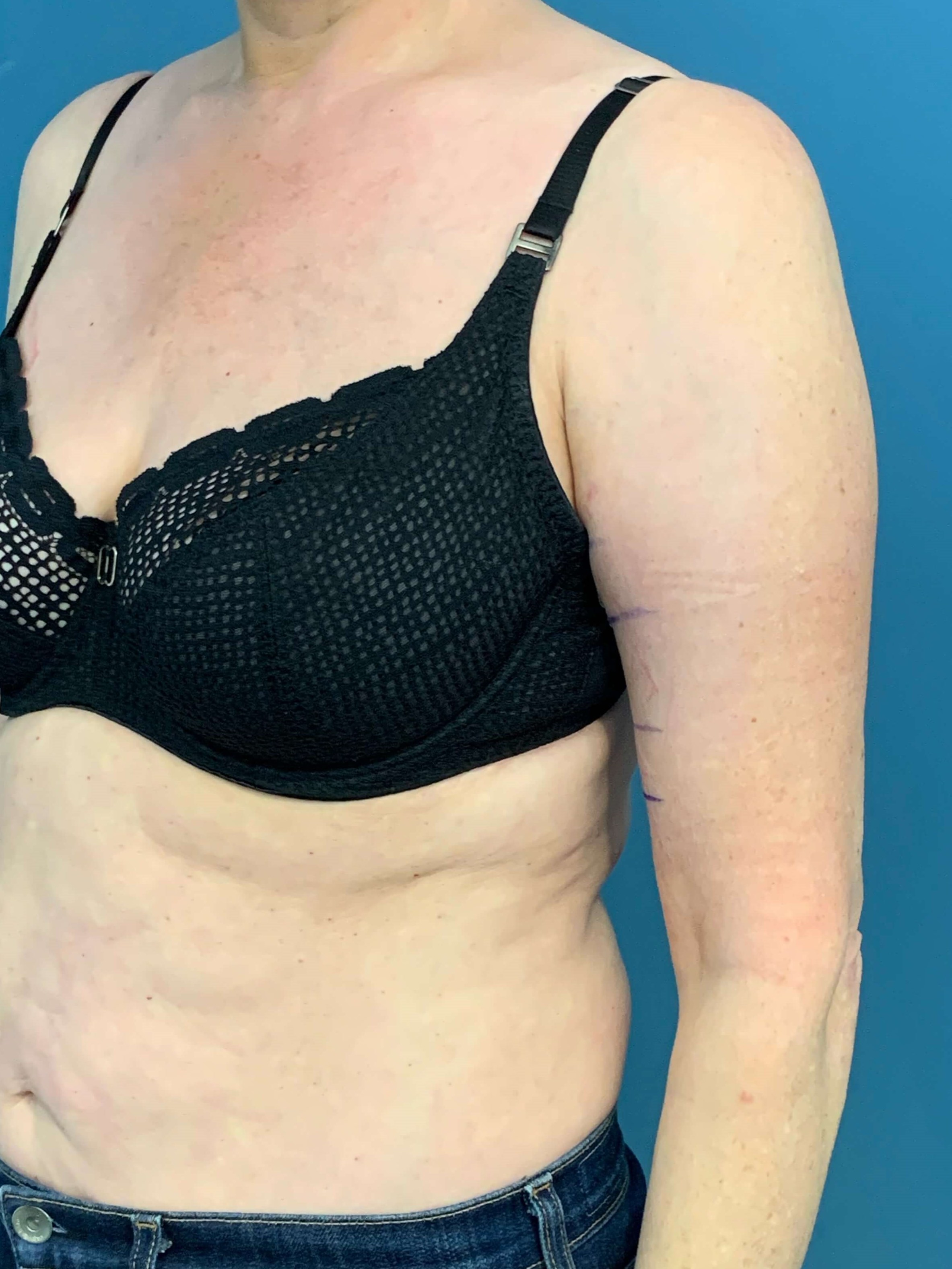In Office Arm Lift (Brachioplasty) — after, view 4
