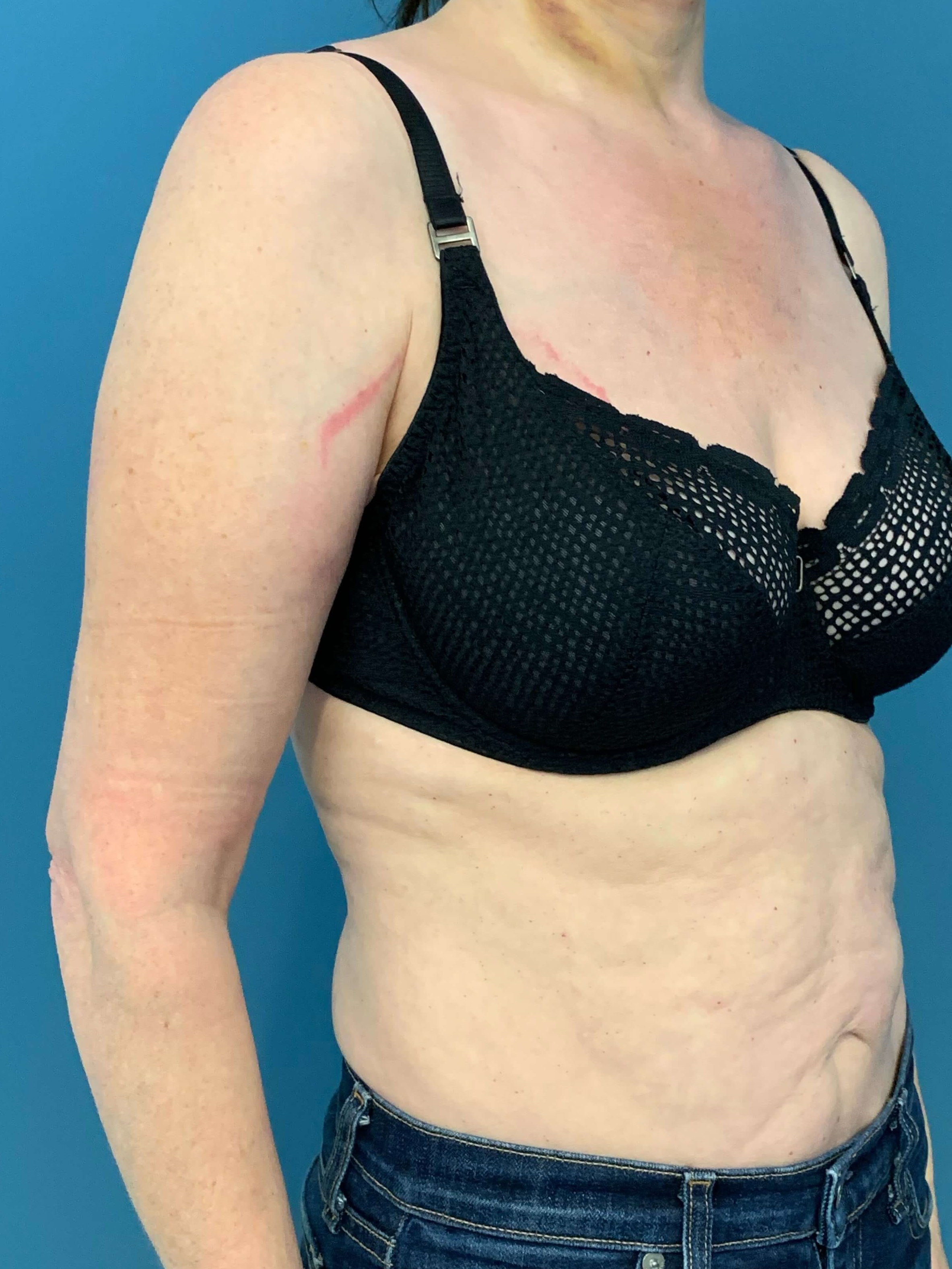 In Office Arm Lift (Brachioplasty) — after, view 5