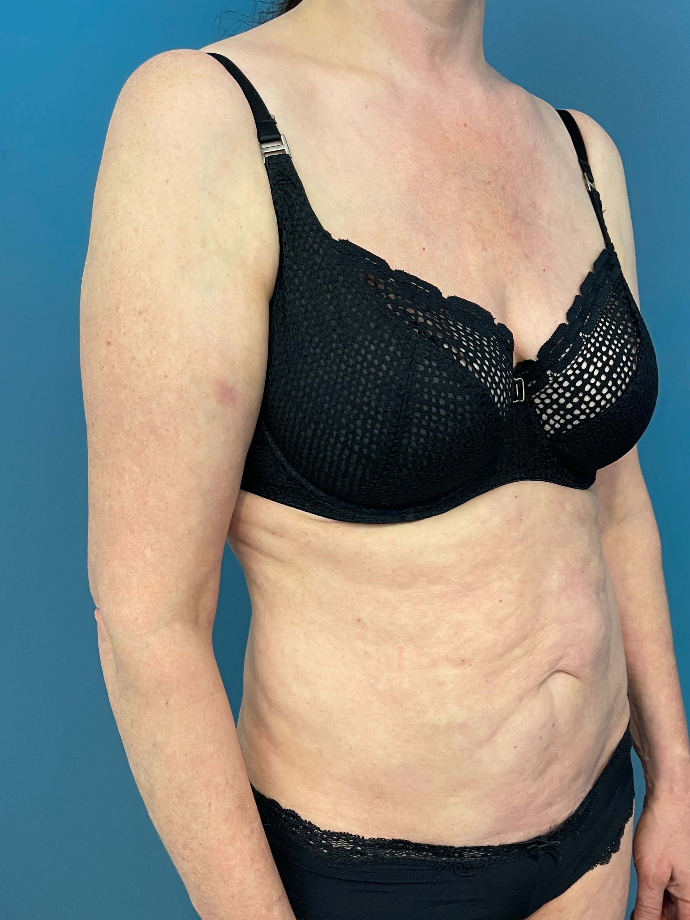 In Office Arm Lift (Brachioplasty) — before, view 5