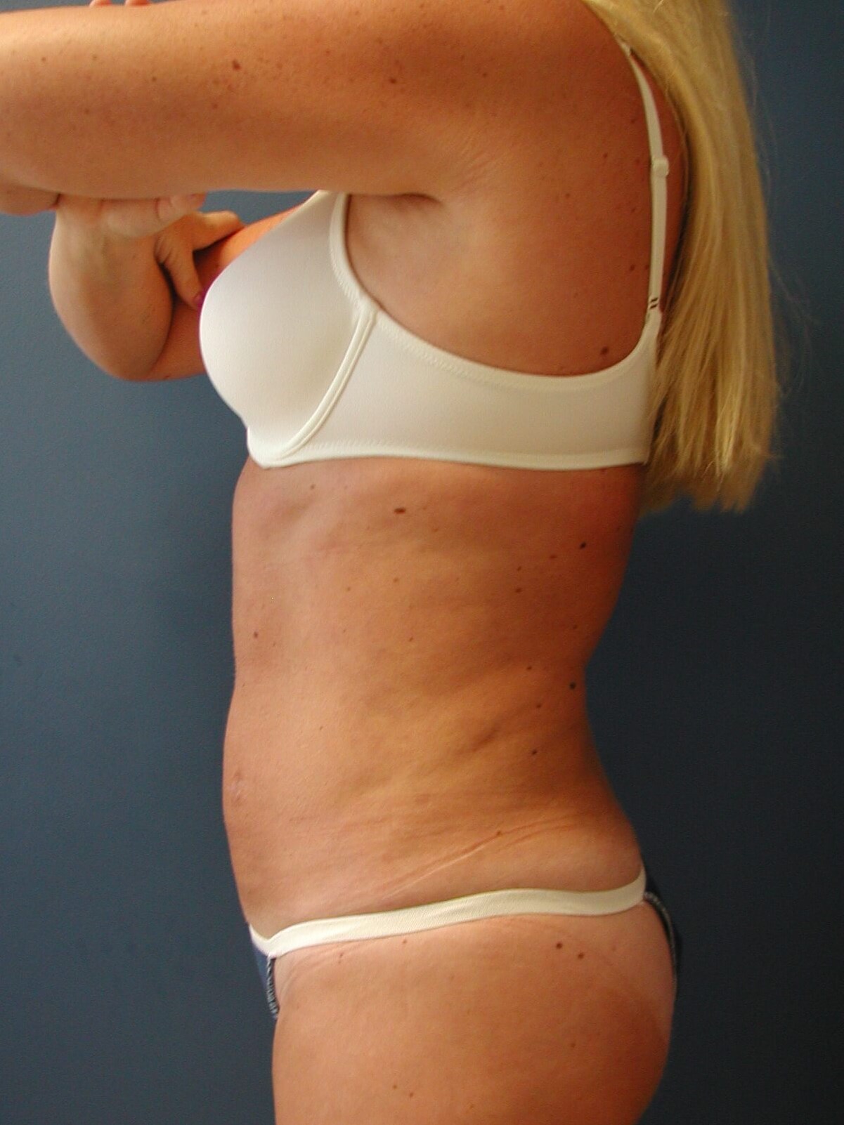 Liposuction of the Abdomen, Flanks, and Back, and Circumferential Contouring — before, view 2