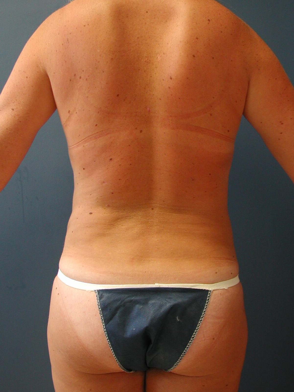 Liposuction of the Abdomen, Flanks, and Back, and Circumferential Contouring — after, view 6