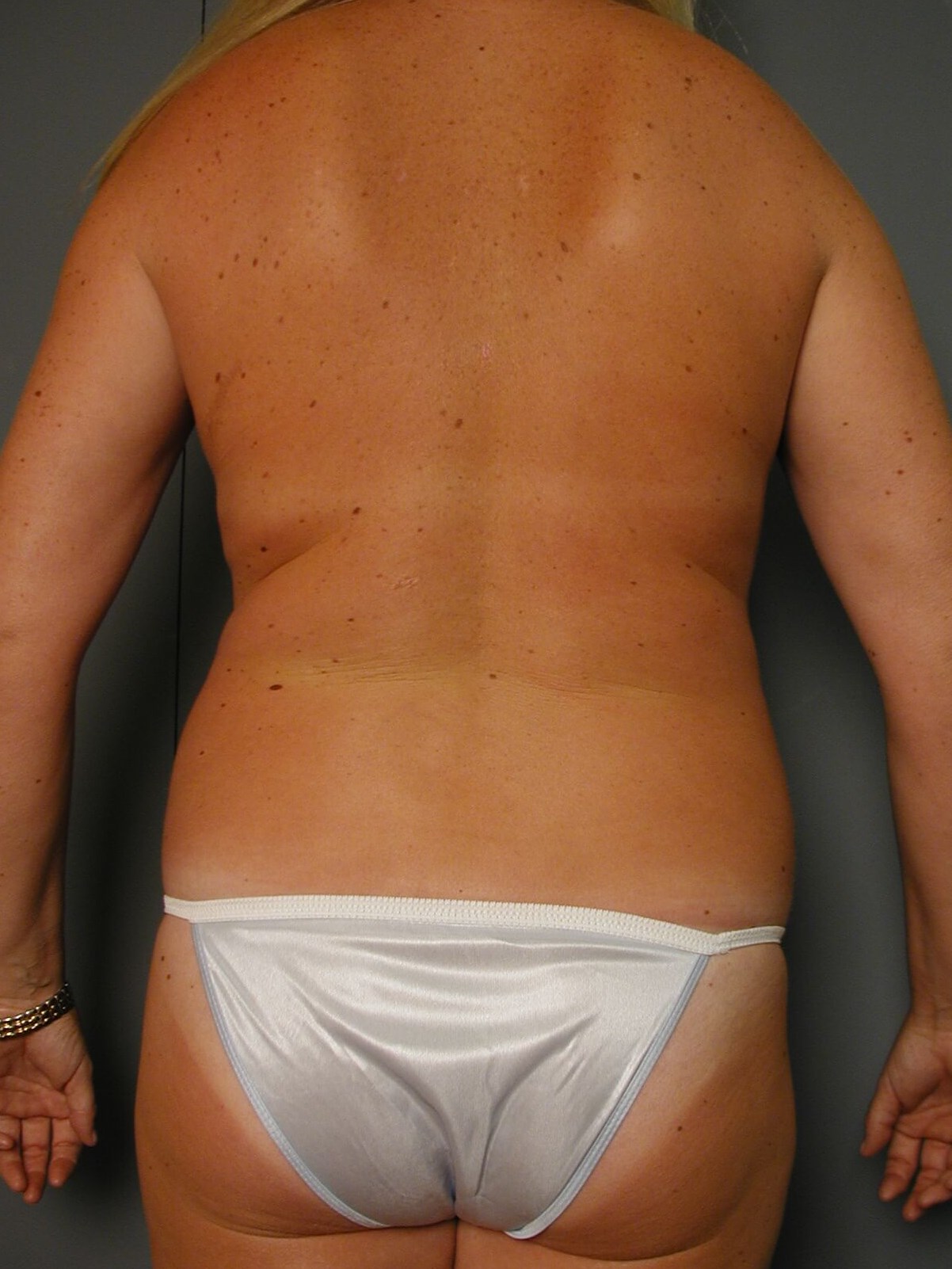 Liposuction of the Abdomen, Flanks, and Back, and Circumferential Contouring — before, view 6