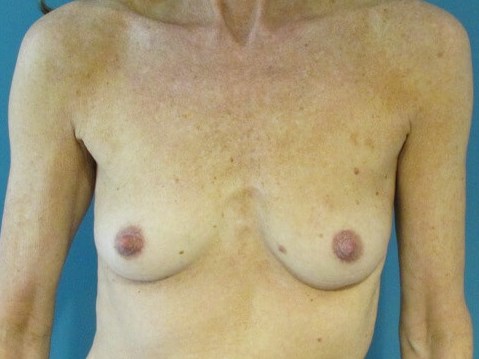 Breast Aug — before, view 1