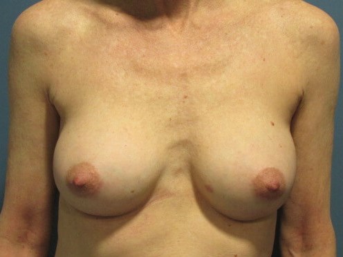 Breast Aug
