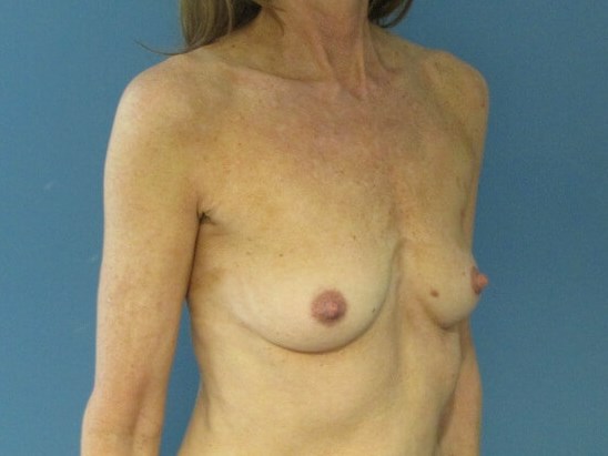 Breast Aug — before, view 3