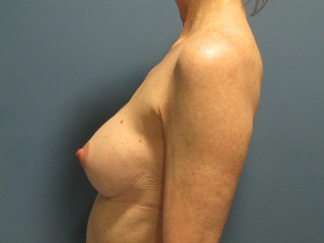 Breast Aug — after, view 4