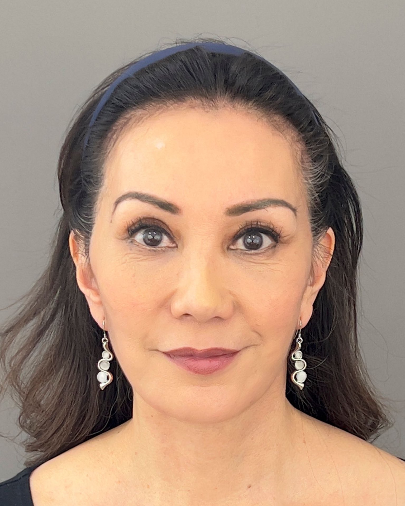 Deep Plane Facelift, Neck Lift & Endoscopic Brow Lift for Facial Rejuvenation