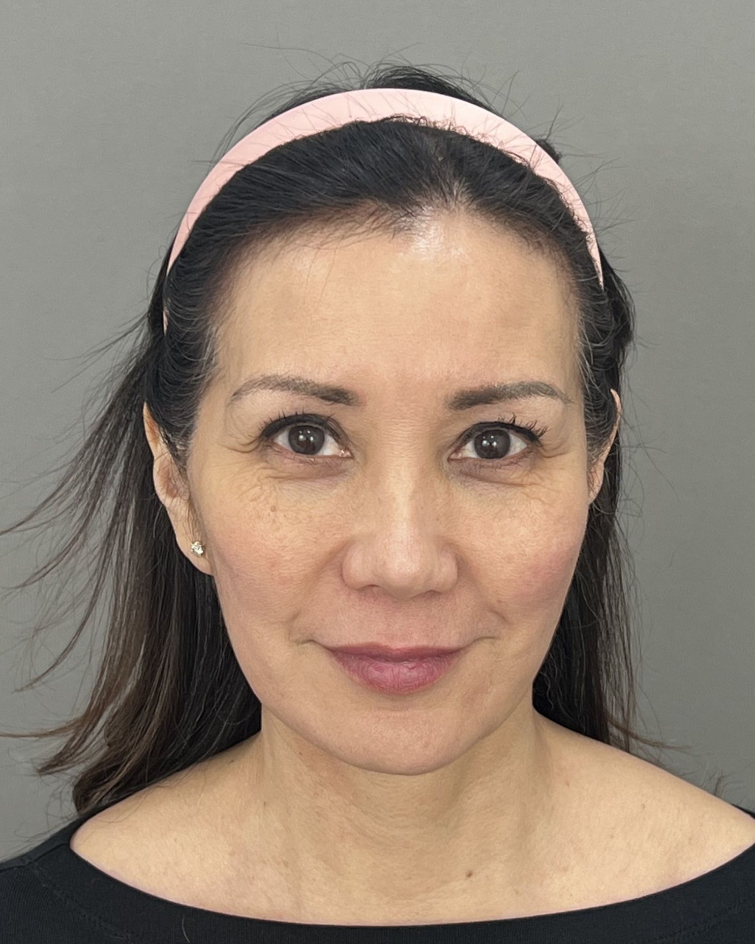 Deep Plane Facelift, Neck Lift & Endoscopic Brow Lift for Facial Rejuvenation — before, view 1