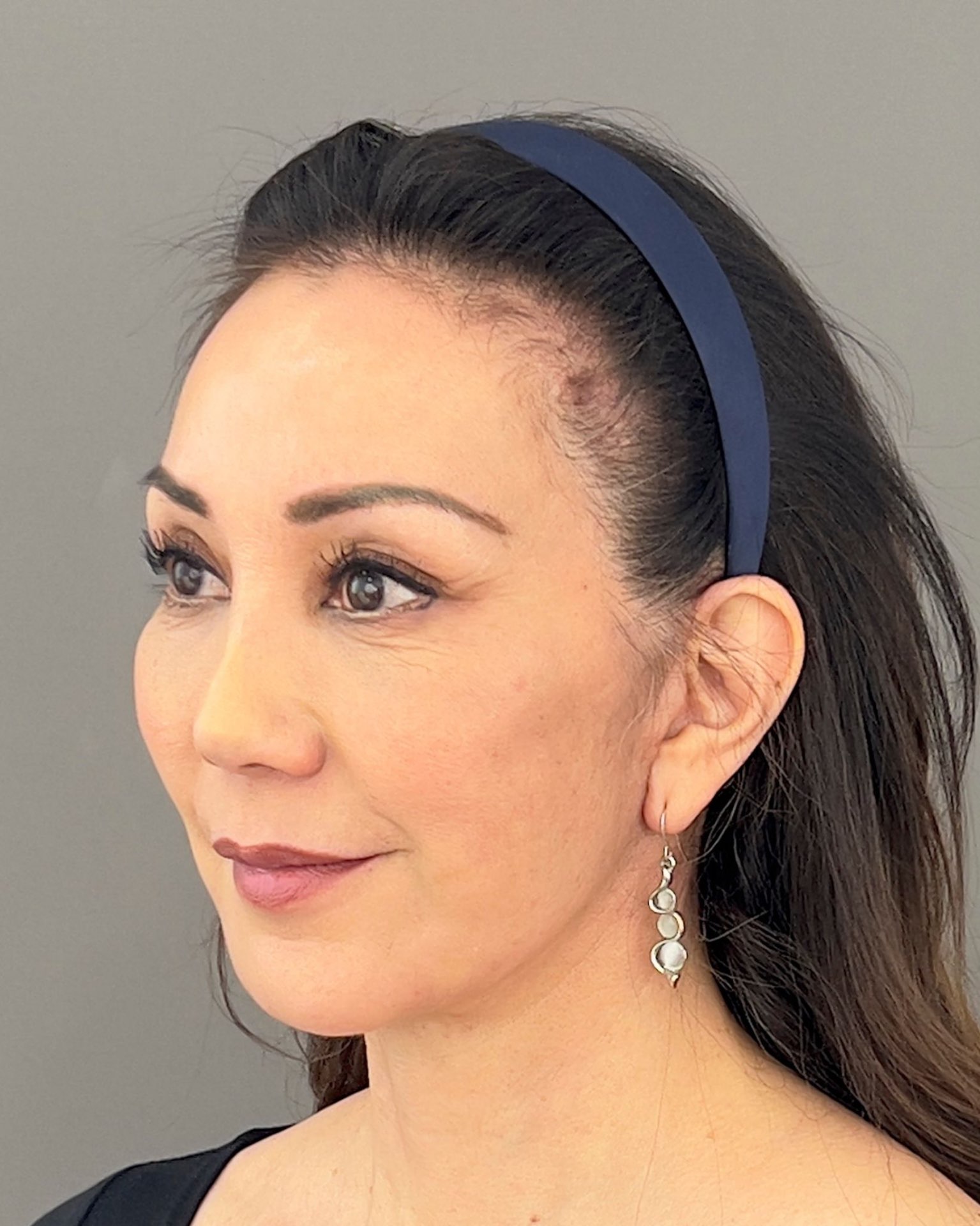Deep Plane Facelift, Neck Lift & Endoscopic Brow Lift for Facial Rejuvenation — after, view 4