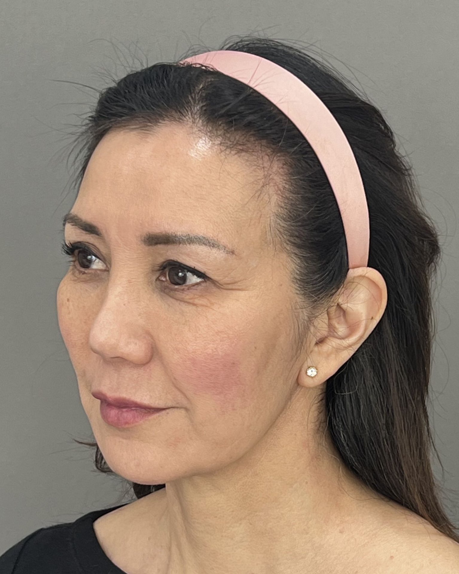 Deep Plane Facelift, Neck Lift & Endoscopic Brow Lift for Facial Rejuvenation — before, view 4