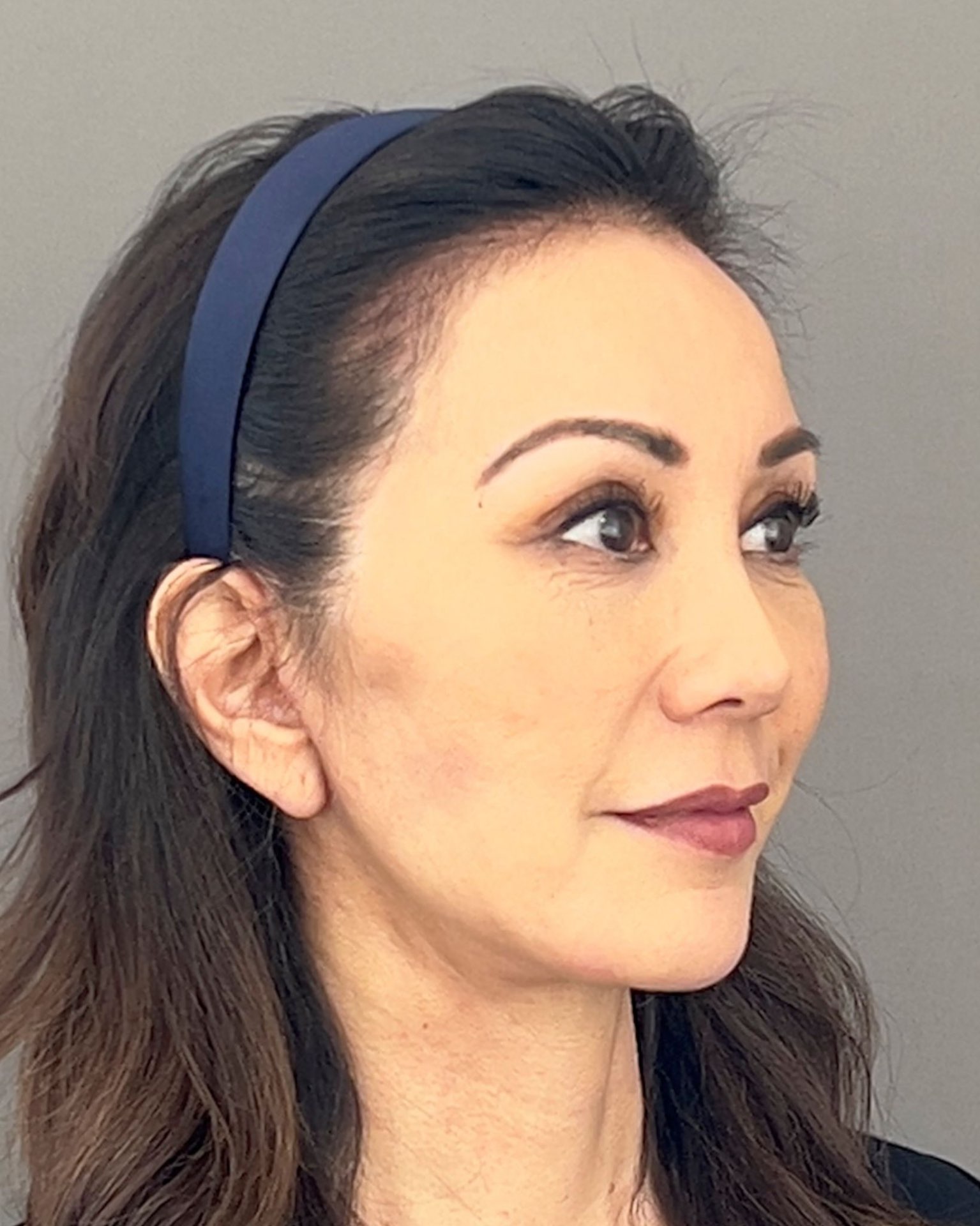 Deep Plane Facelift, Neck Lift & Endoscopic Brow Lift for Facial Rejuvenation — after, view 2