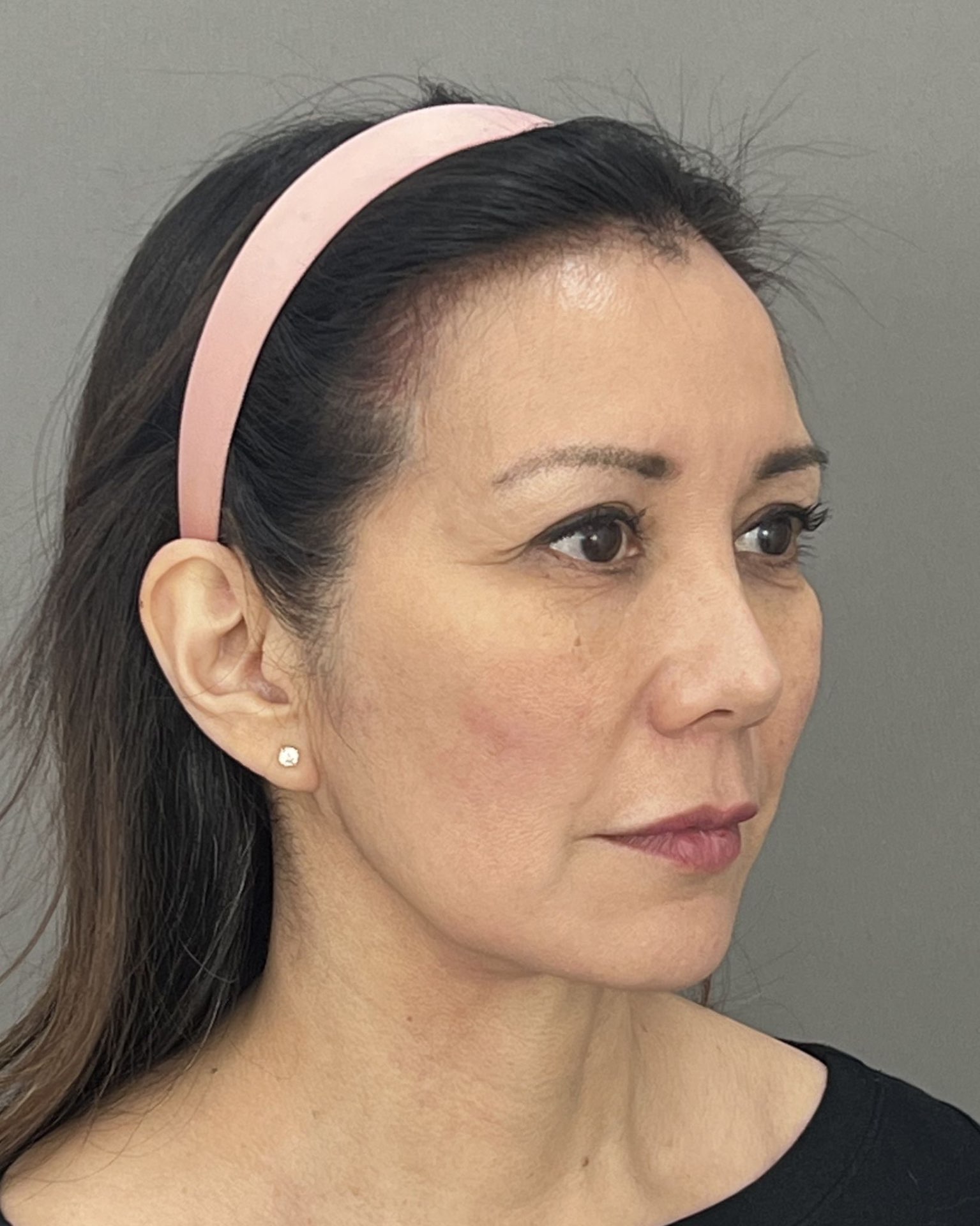 Deep Plane Facelift, Neck Lift & Endoscopic Brow Lift for Facial Rejuvenation — before, view 2