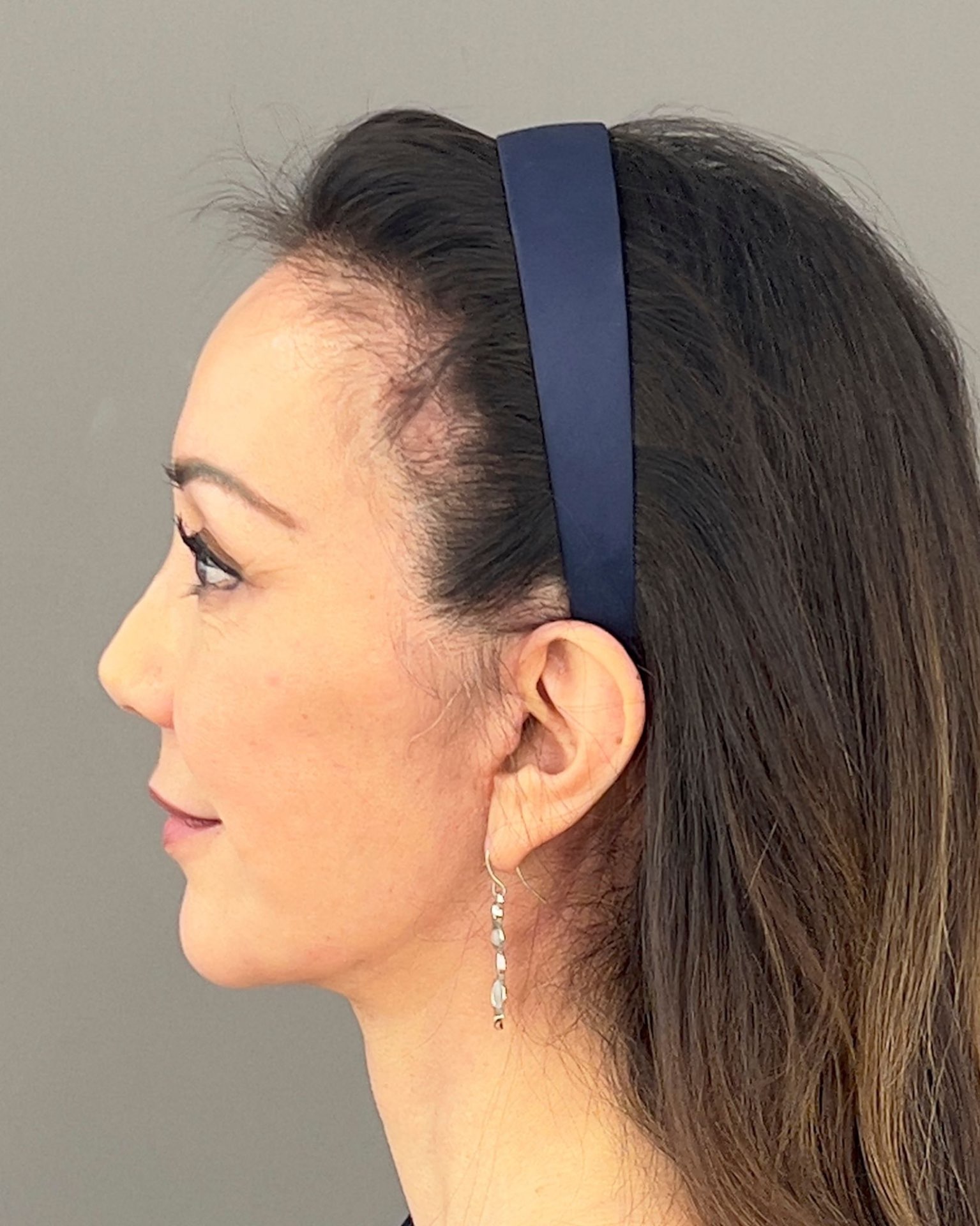 Deep Plane Facelift, Neck Lift & Endoscopic Brow Lift for Facial Rejuvenation — after, view 5