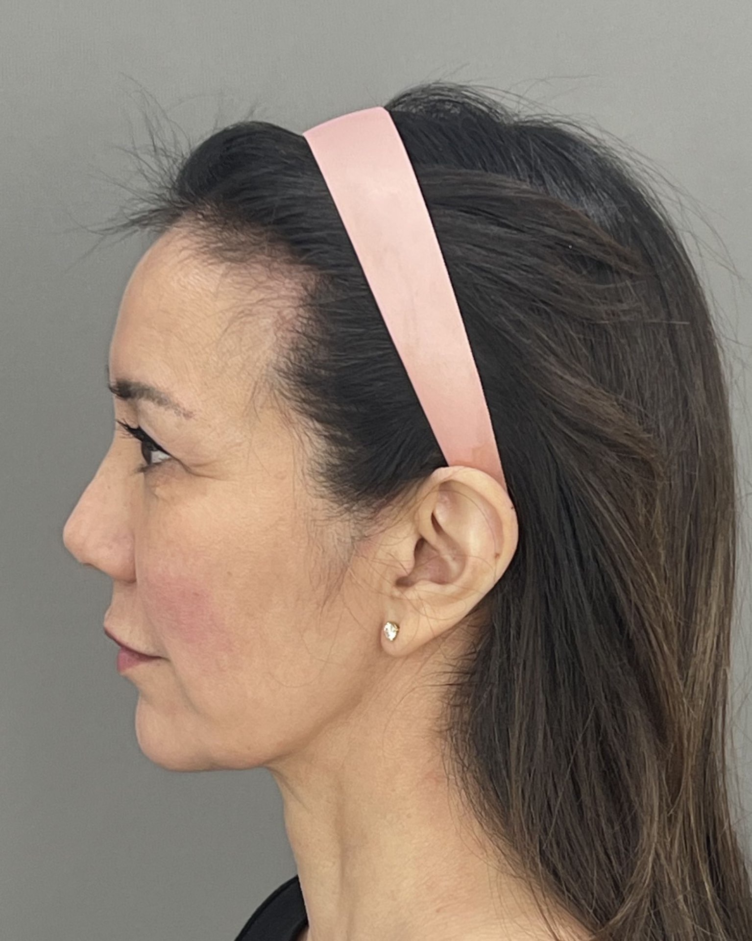 Deep Plane Facelift, Neck Lift & Endoscopic Brow Lift for Facial Rejuvenation — before, view 5