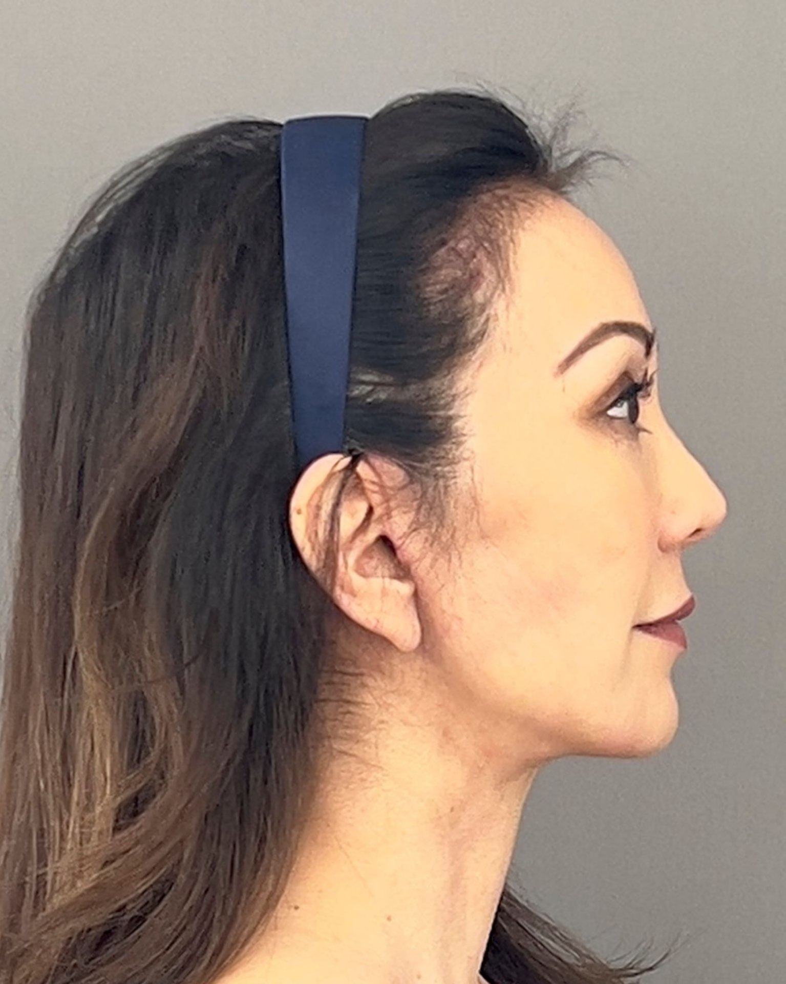 Deep Plane Facelift, Neck Lift & Endoscopic Brow Lift for Facial Rejuvenation — after, view 3