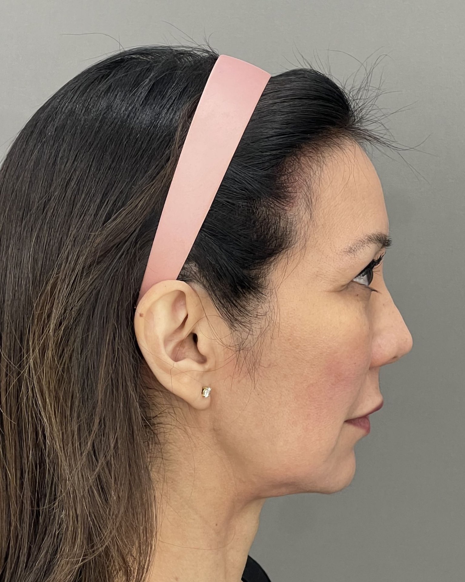 Deep Plane Facelift, Neck Lift & Endoscopic Brow Lift for Facial Rejuvenation — before, view 3
