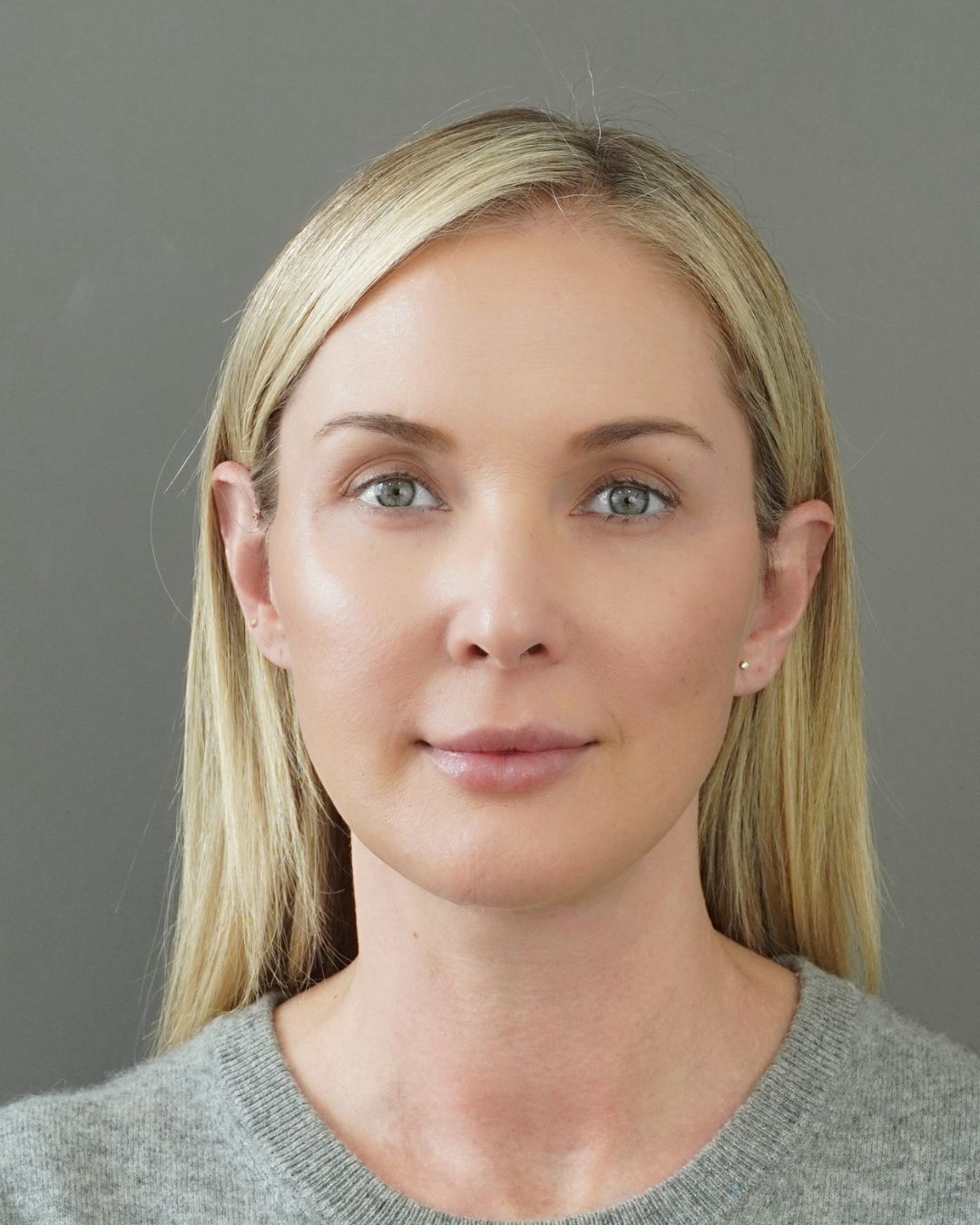 Deep Plane Facelift, Neck Lift, Buccal Fat Removal & Endoscopic Brow Lift Before and After | Early 40s Facial Rejuvenation