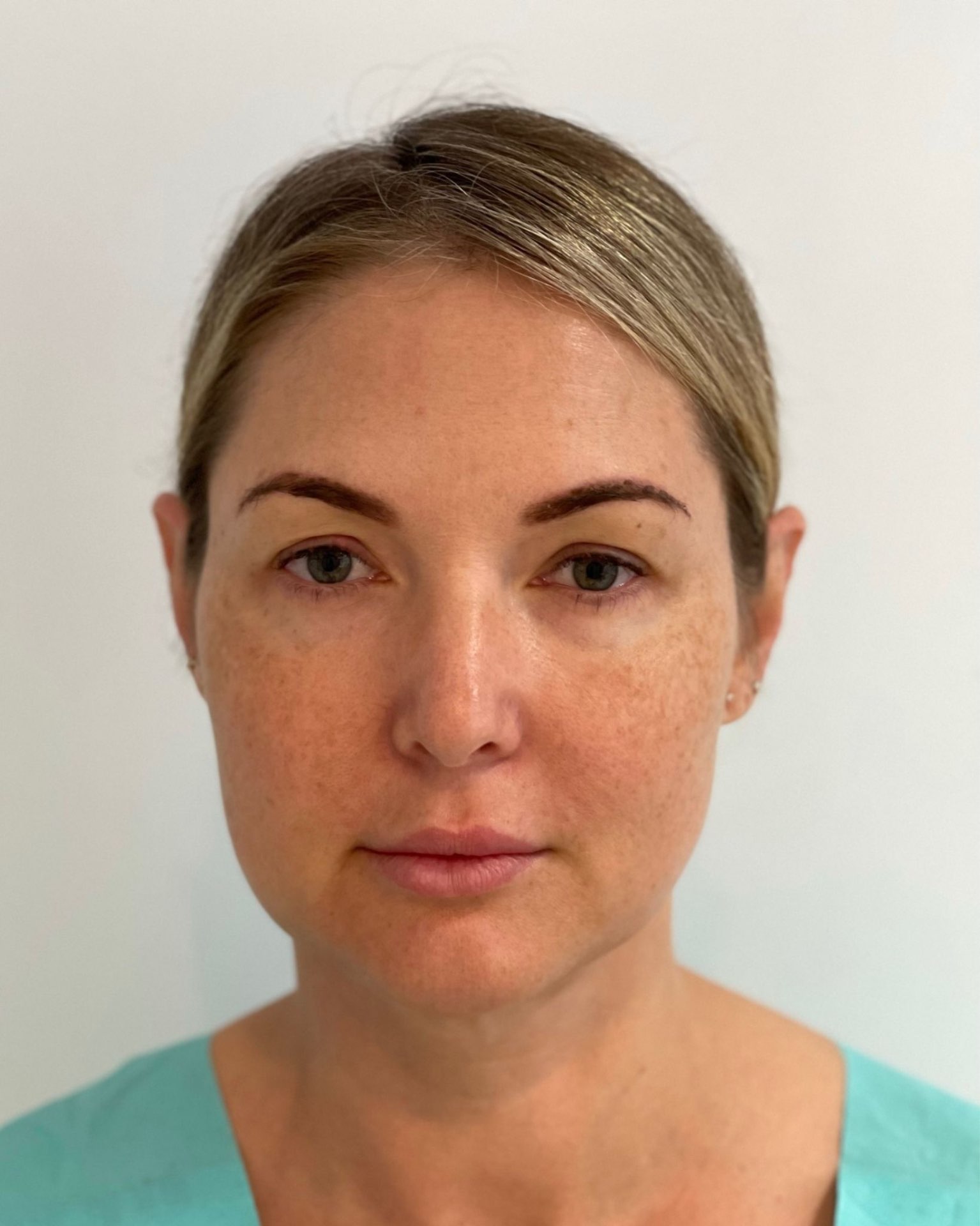 Deep Plane Facelift, Neck Lift, Buccal Fat Removal & Endoscopic Brow Lift Before and After | Early 40s Facial Rejuvenation — before, view 1
