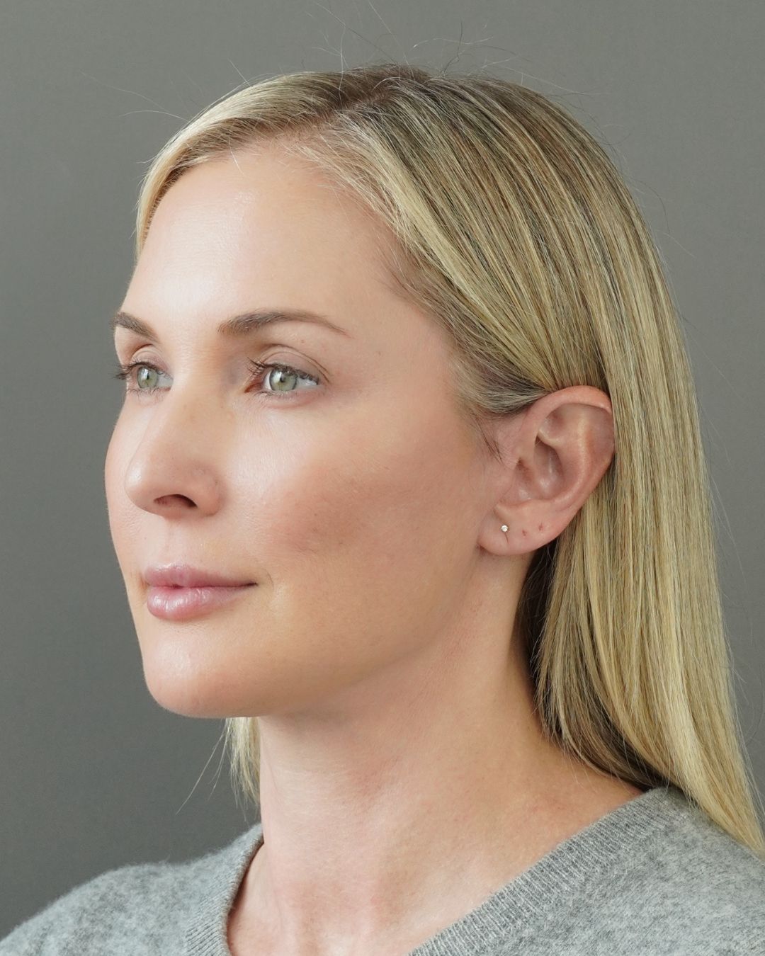 Deep Plane Facelift, Neck Lift, Buccal Fat Removal & Endoscopic Brow Lift Before and After | Early 40s Facial Rejuvenation — after, view 4