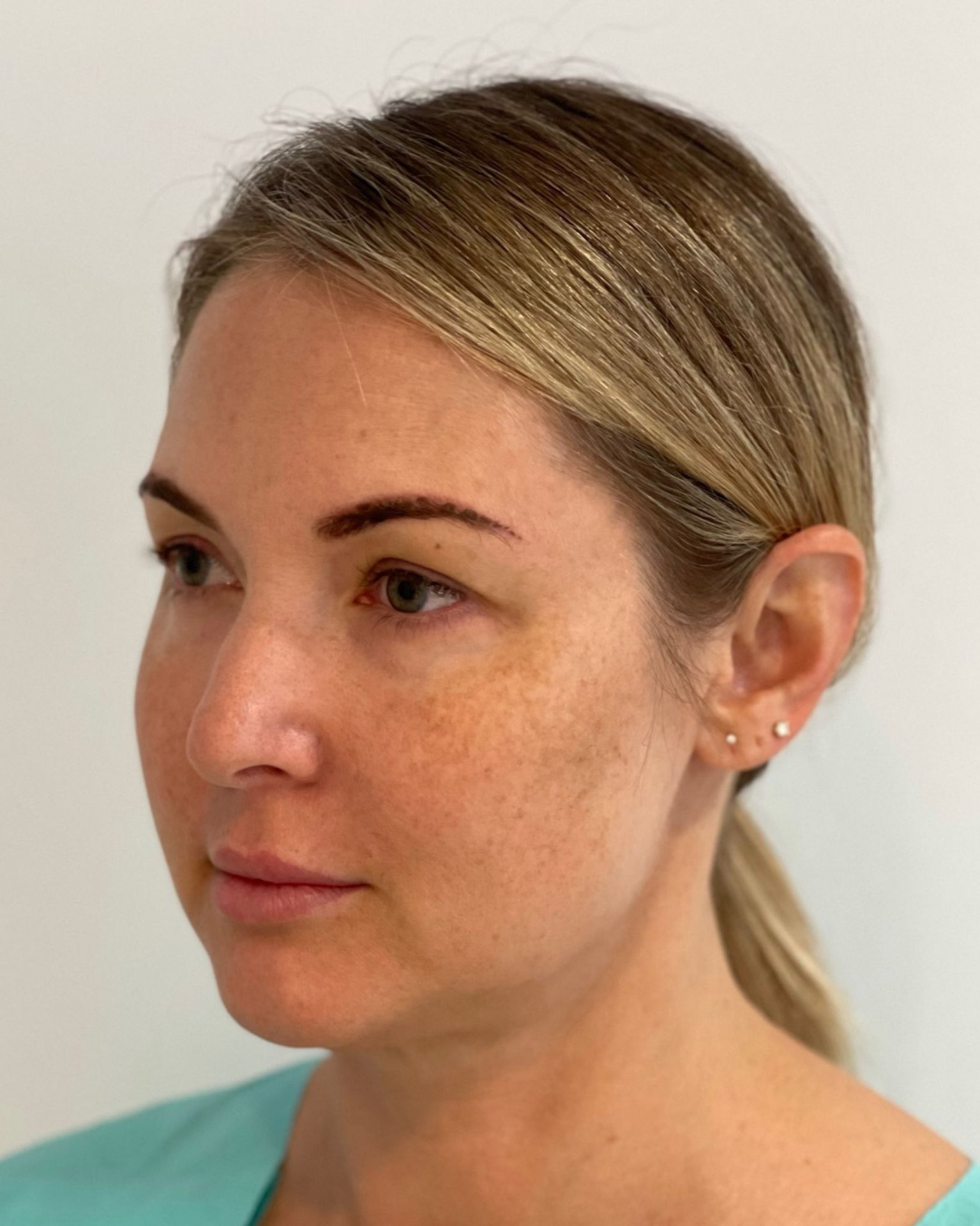 Deep Plane Facelift, Neck Lift, Buccal Fat Removal & Endoscopic Brow Lift Before and After | Early 40s Facial Rejuvenation — before, view 4
