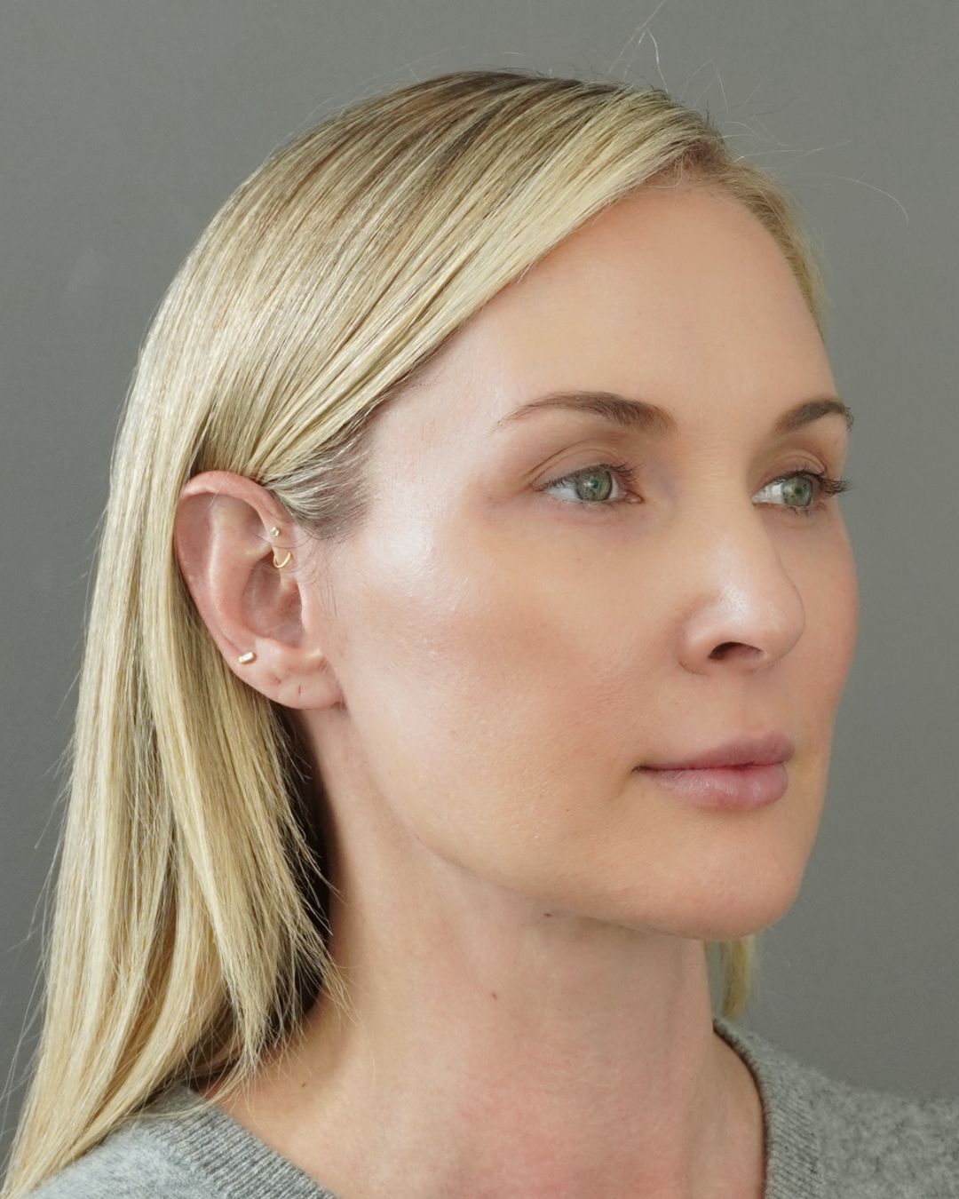 Deep Plane Facelift, Neck Lift, Buccal Fat Removal & Endoscopic Brow Lift Before and After | Early 40s Facial Rejuvenation — after, view 2
