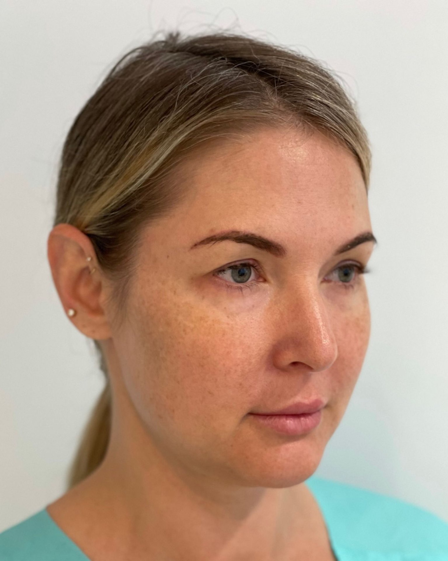 Deep Plane Facelift, Neck Lift, Buccal Fat Removal & Endoscopic Brow Lift Before and After | Early 40s Facial Rejuvenation — before, view 2