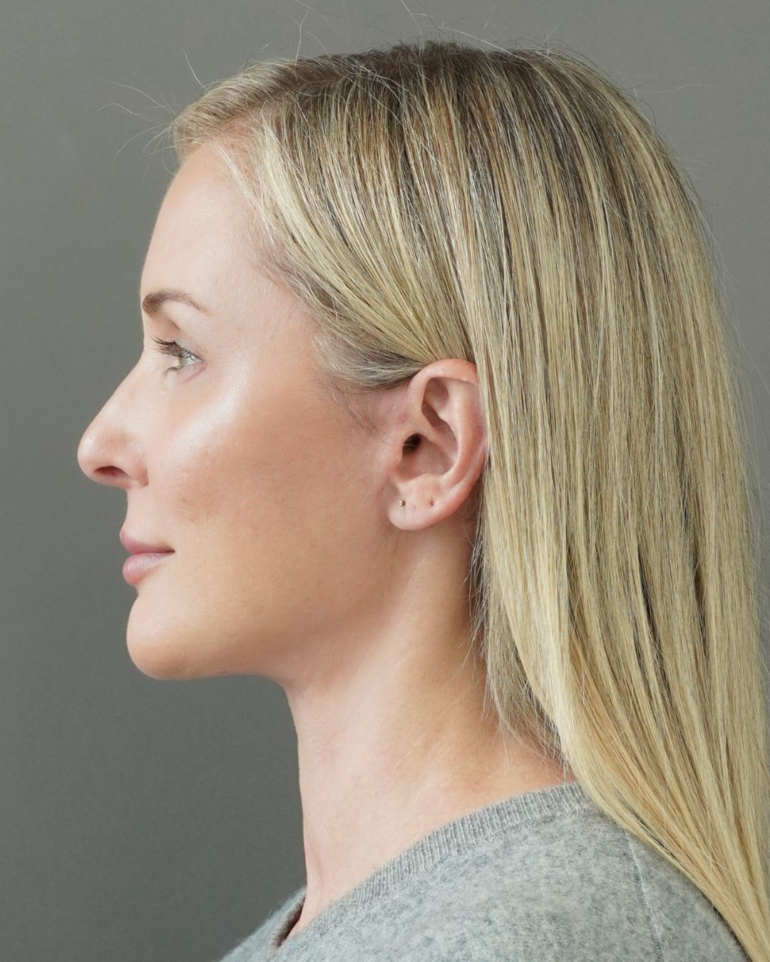 Deep Plane Facelift, Neck Lift, Buccal Fat Removal & Endoscopic Brow Lift Before and After | Early 40s Facial Rejuvenation — after, view 5