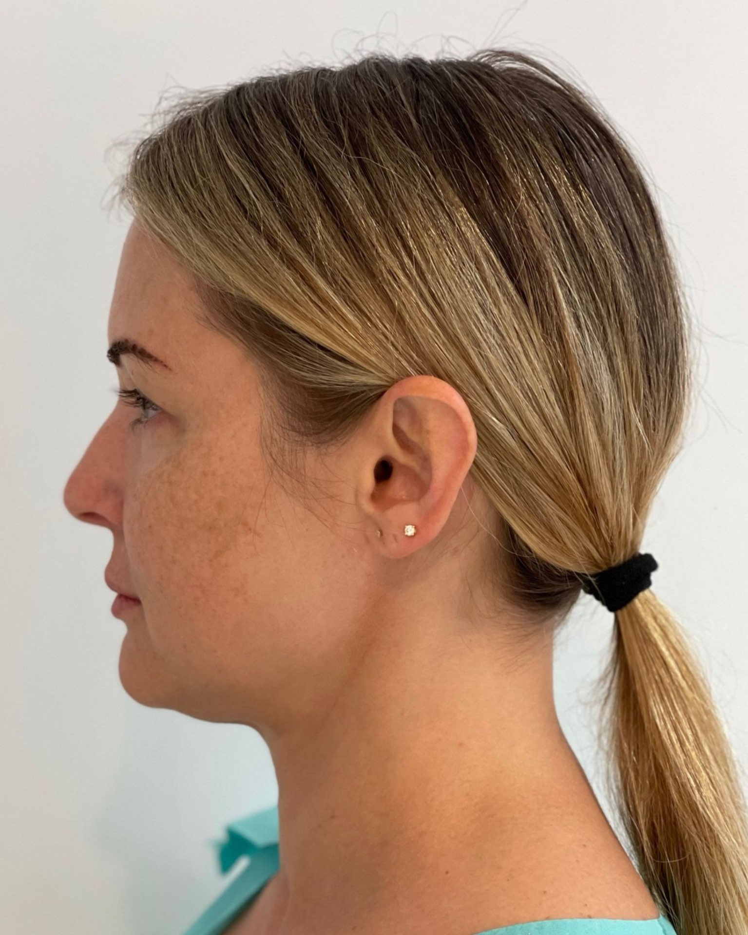 Deep Plane Facelift, Neck Lift, Buccal Fat Removal & Endoscopic Brow Lift Before and After | Early 40s Facial Rejuvenation — before, view 5