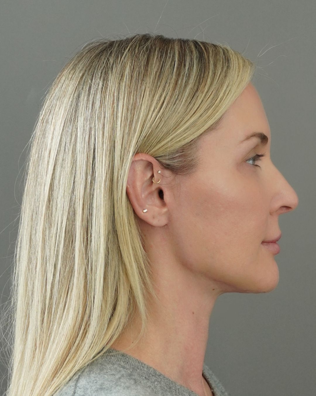 Deep Plane Facelift, Neck Lift, Buccal Fat Removal & Endoscopic Brow Lift Before and After | Early 40s Facial Rejuvenation — after, view 3