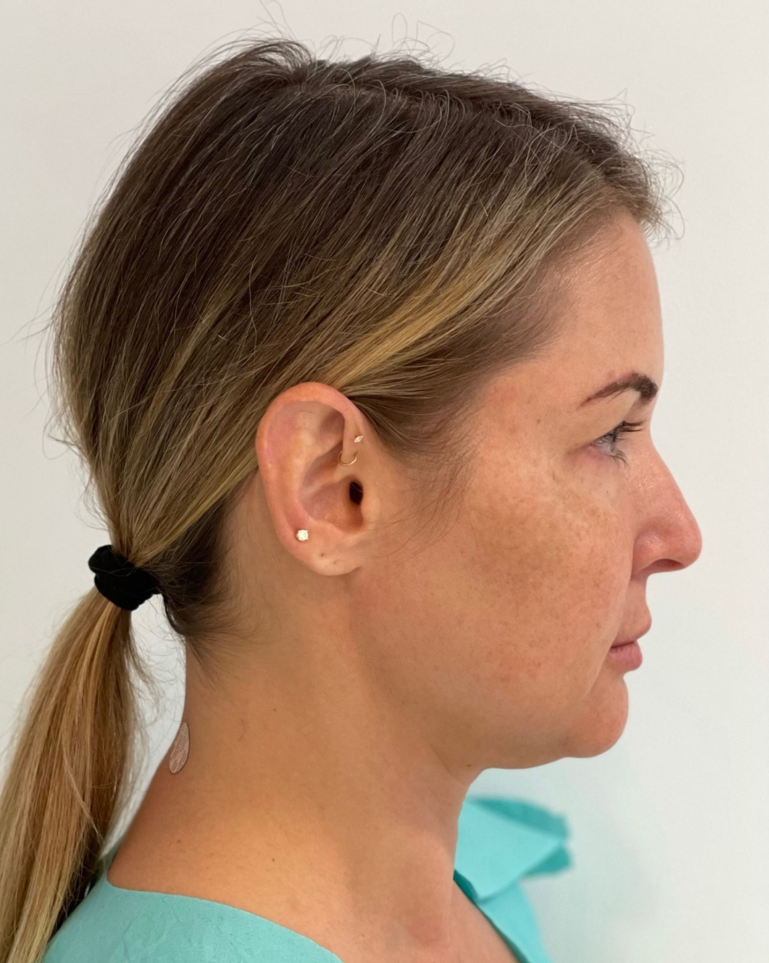 Deep Plane Facelift, Neck Lift, Buccal Fat Removal & Endoscopic Brow Lift Before and After | Early 40s Facial Rejuvenation — before, view 3