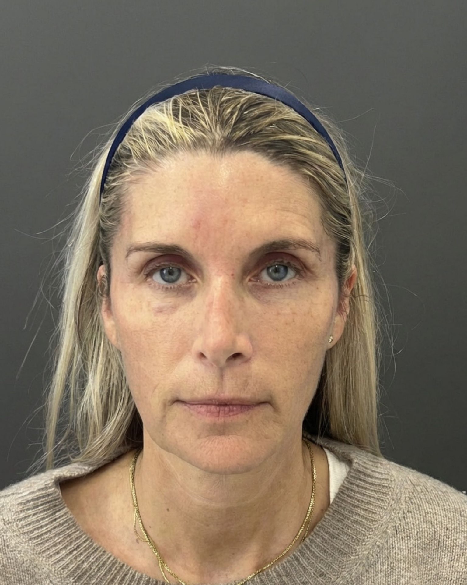 Endoscopic Brow Lift, Deep Plane Facelift & Neck Lift Before and After — before, view 1