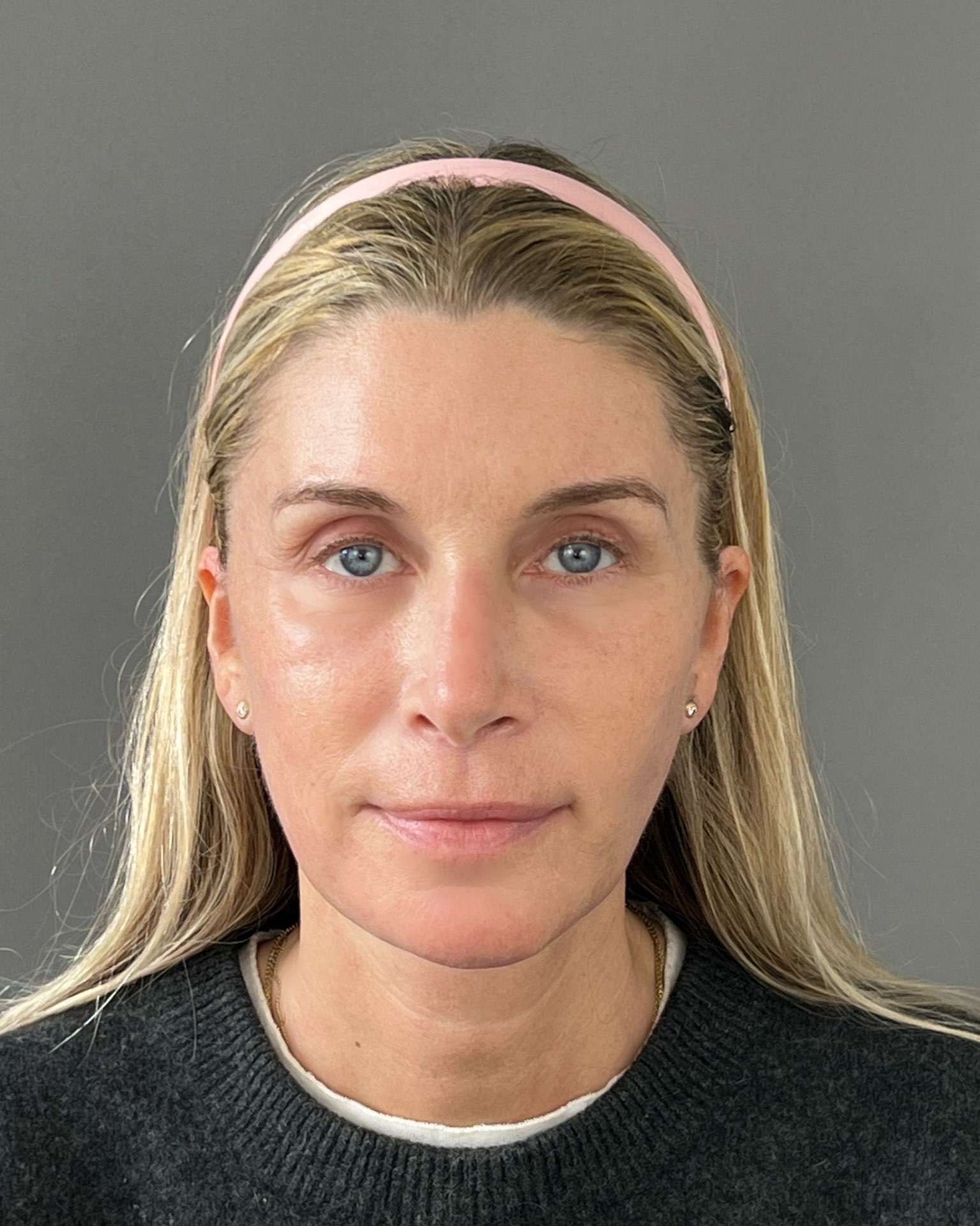Endoscopic Brow Lift, Deep Plane Facelift & Neck Lift Before and After