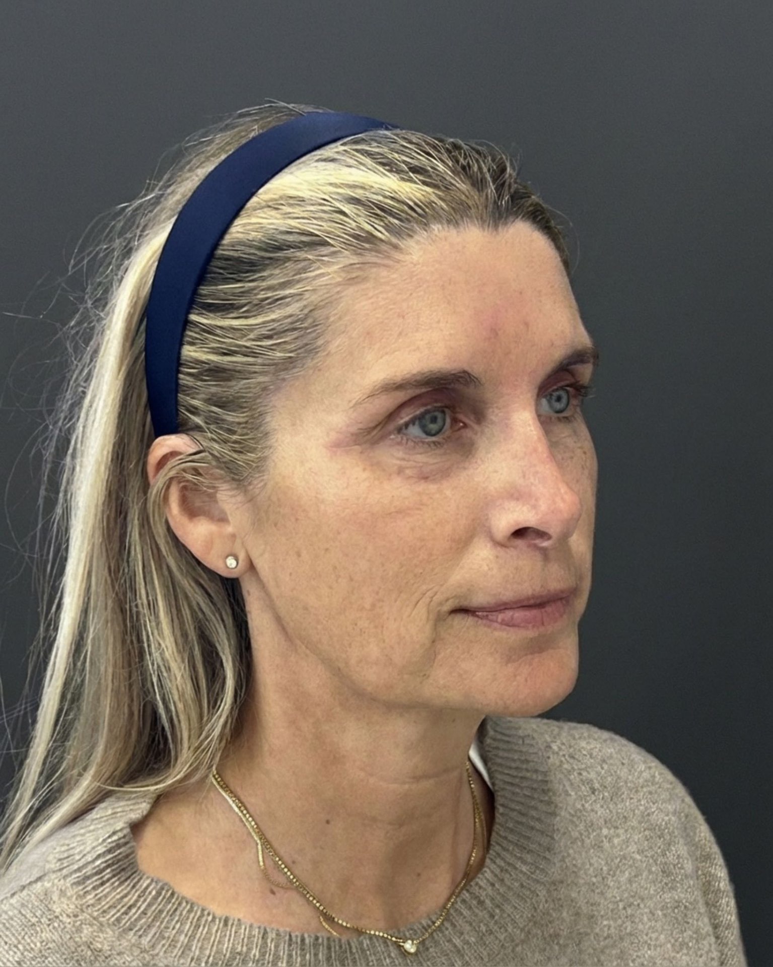 Endoscopic Brow Lift, Deep Plane Facelift & Neck Lift Before and After — before, view 4