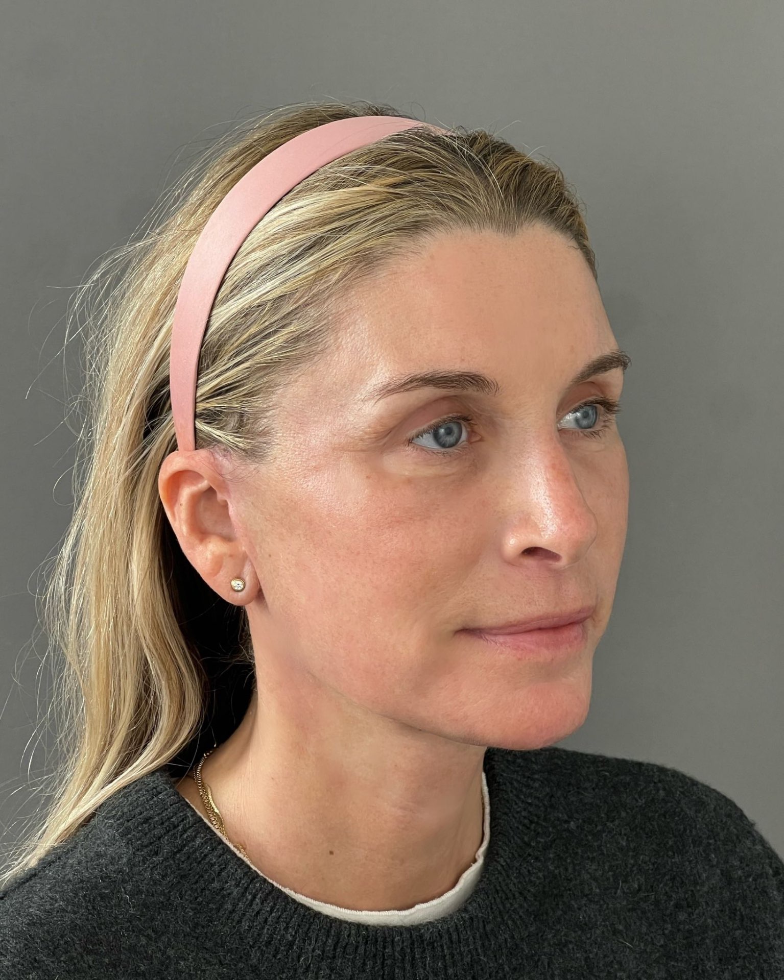 Endoscopic Brow Lift, Deep Plane Facelift & Neck Lift Before and After — after, view 4