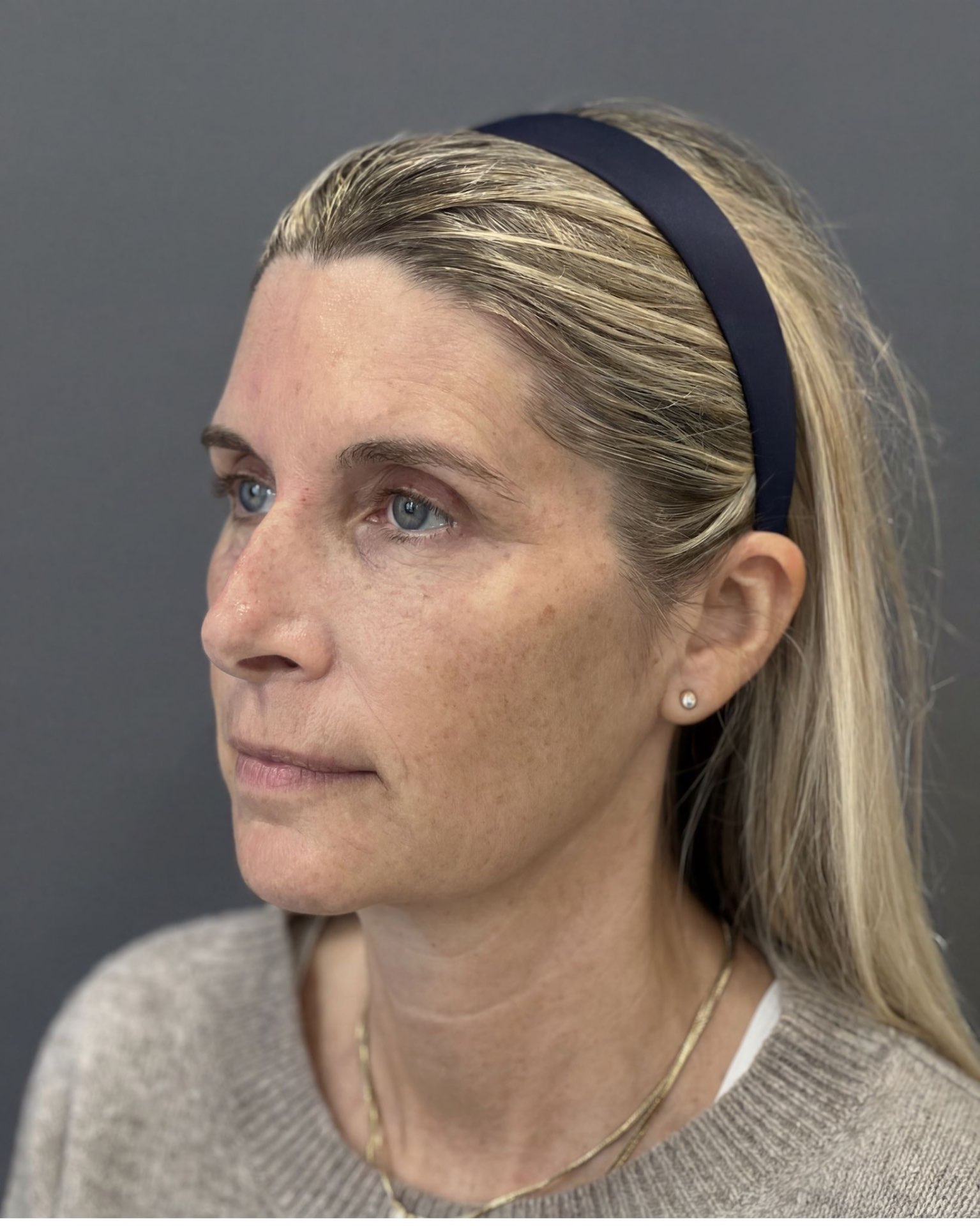 Endoscopic Brow Lift, Deep Plane Facelift & Neck Lift Before and After — before, view 2