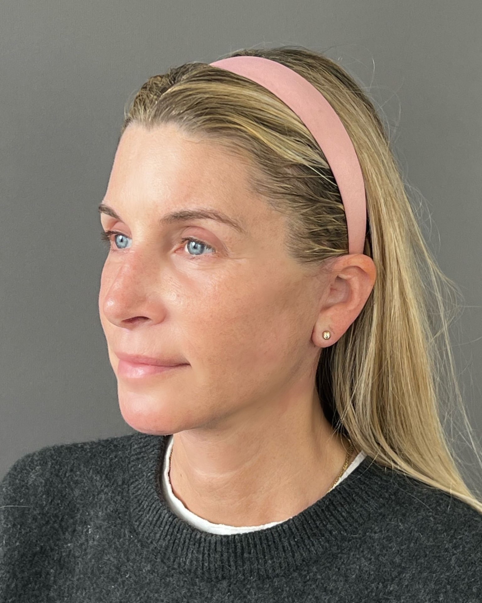 Endoscopic Brow Lift, Deep Plane Facelift & Neck Lift Before and After — after, view 2