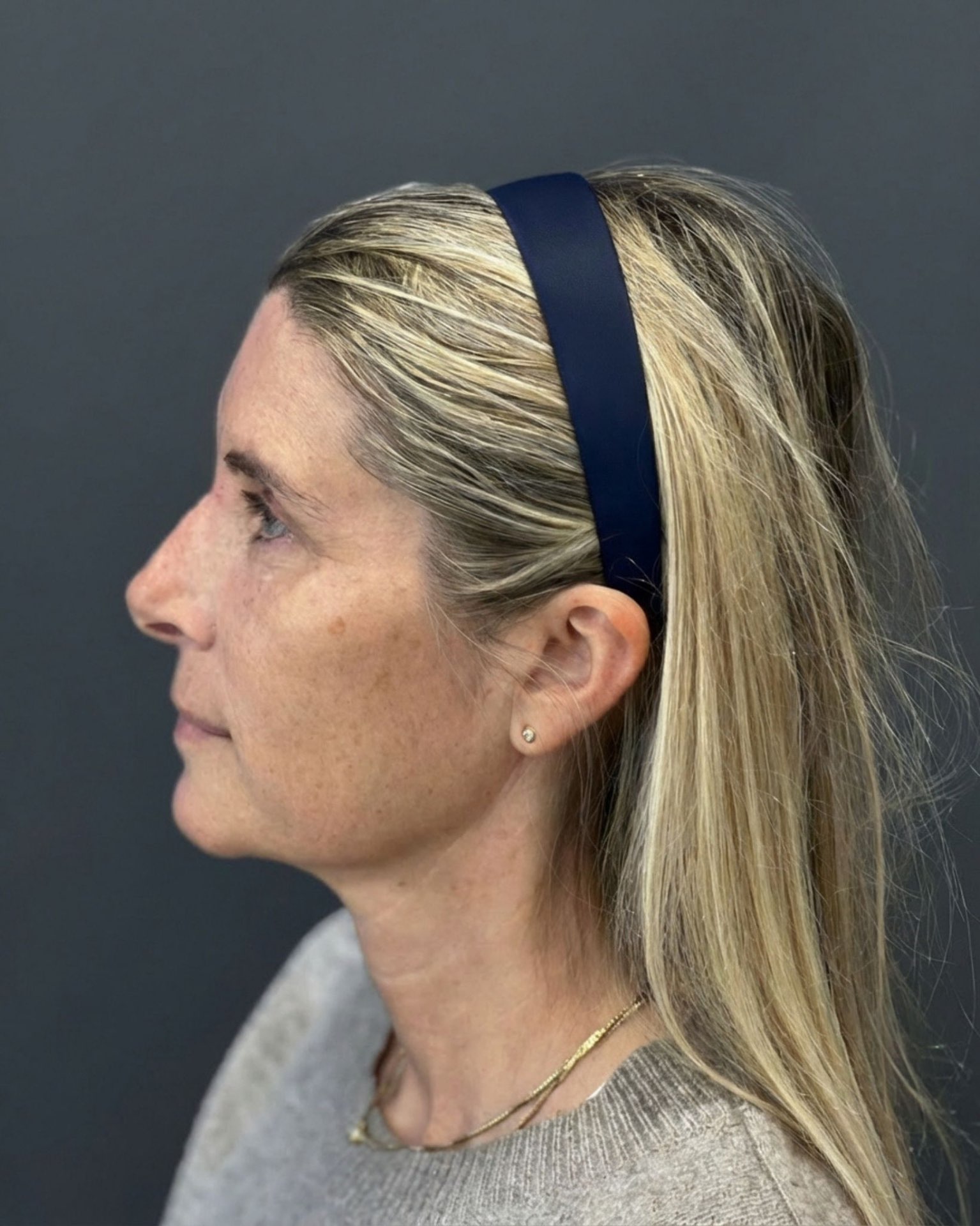 Endoscopic Brow Lift, Deep Plane Facelift & Neck Lift Before and After — before, view 5