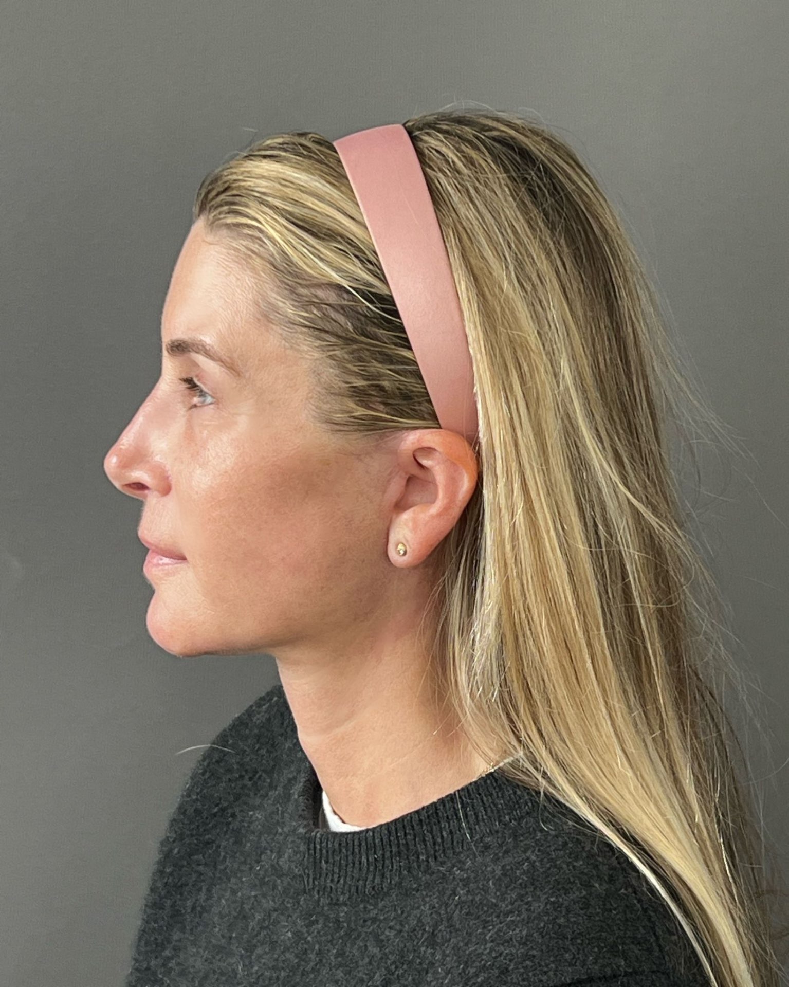 Endoscopic Brow Lift, Deep Plane Facelift & Neck Lift Before and After — after, view 5
