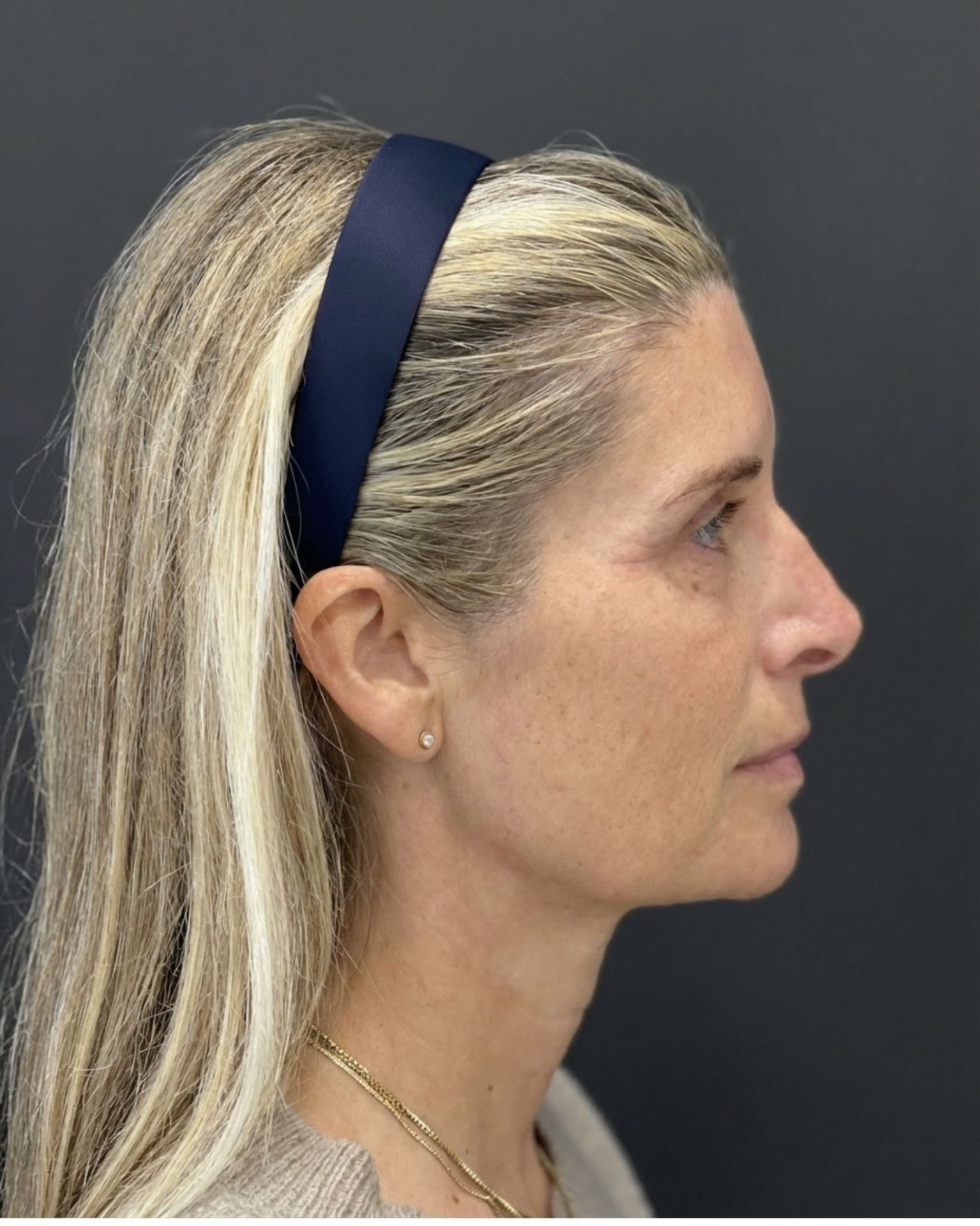 Endoscopic Brow Lift, Deep Plane Facelift & Neck Lift Before and After — before, view 3