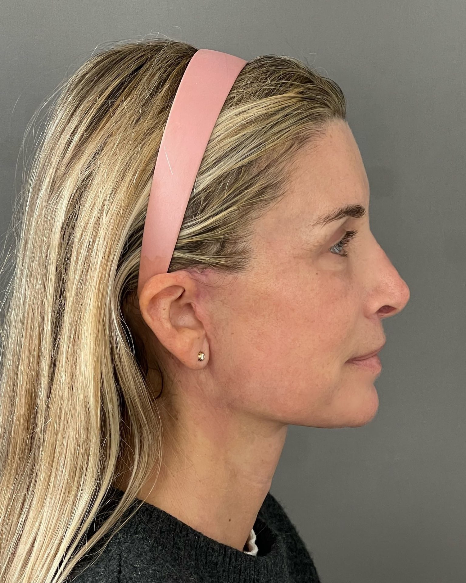 Endoscopic Brow Lift, Deep Plane Facelift & Neck Lift Before and After — after, view 3