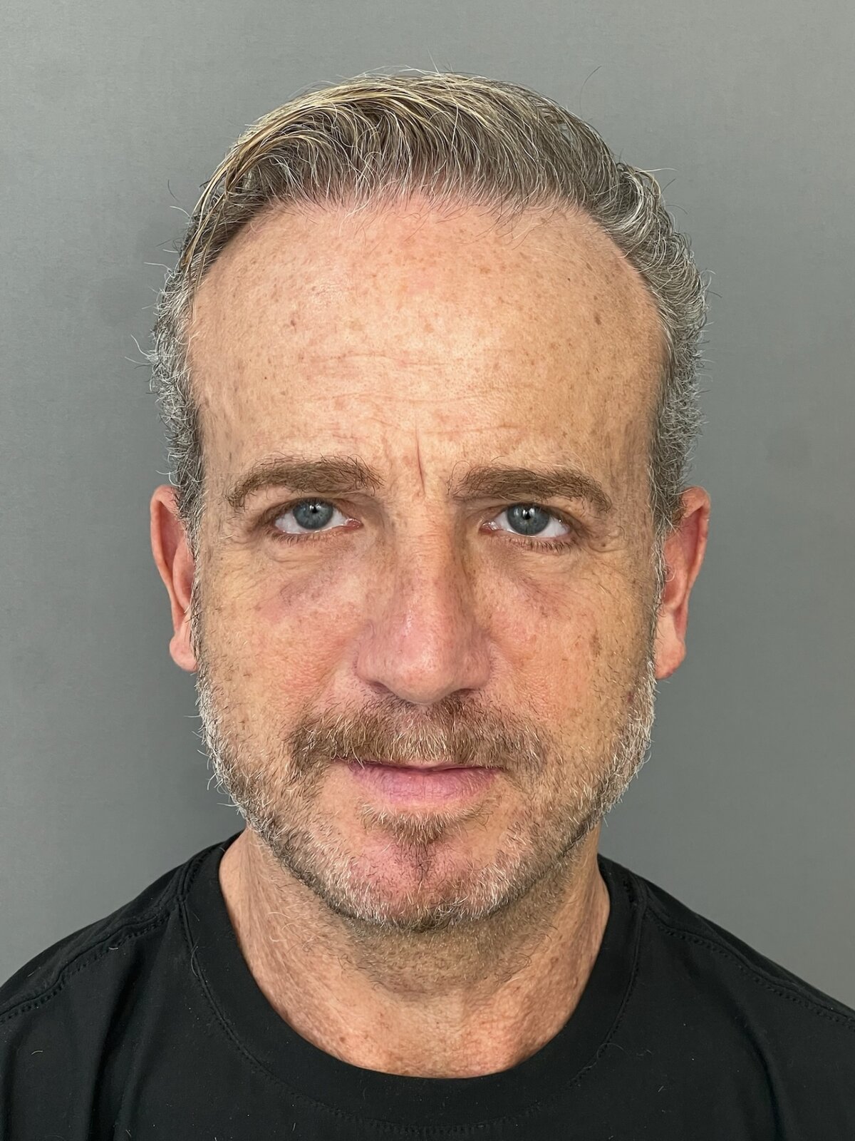 Male Upper & Lower Blepharoplasty in His 60s