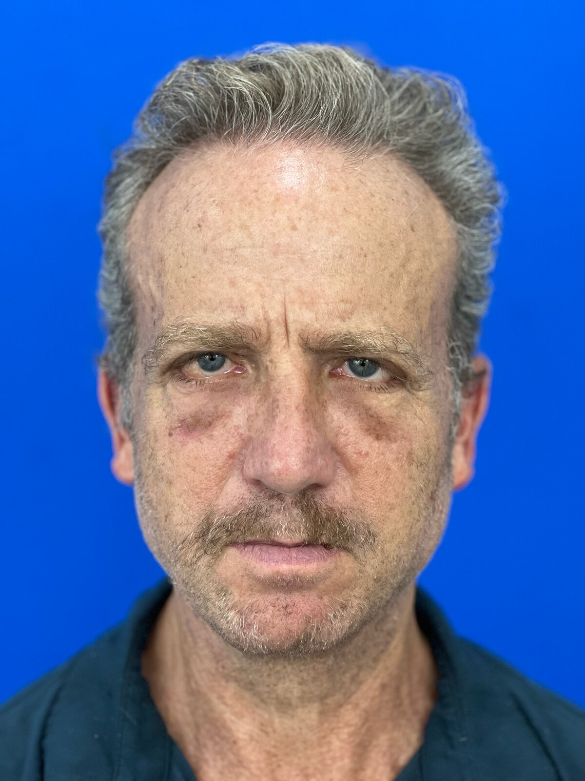 Male Upper & Lower Blepharoplasty in His 60s, before, view 1