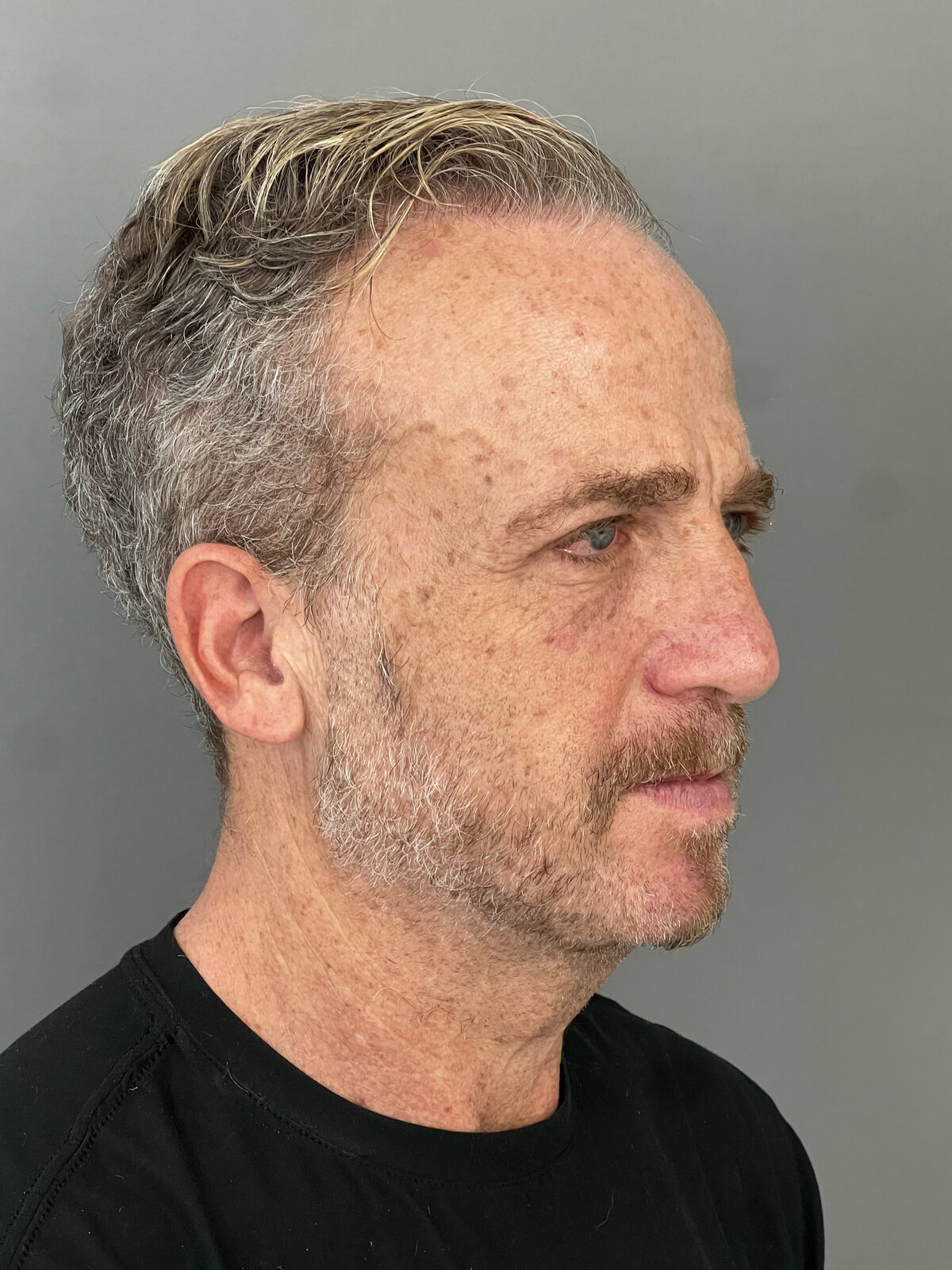 Male Upper & Lower Blepharoplasty in His 60s, after, view 2