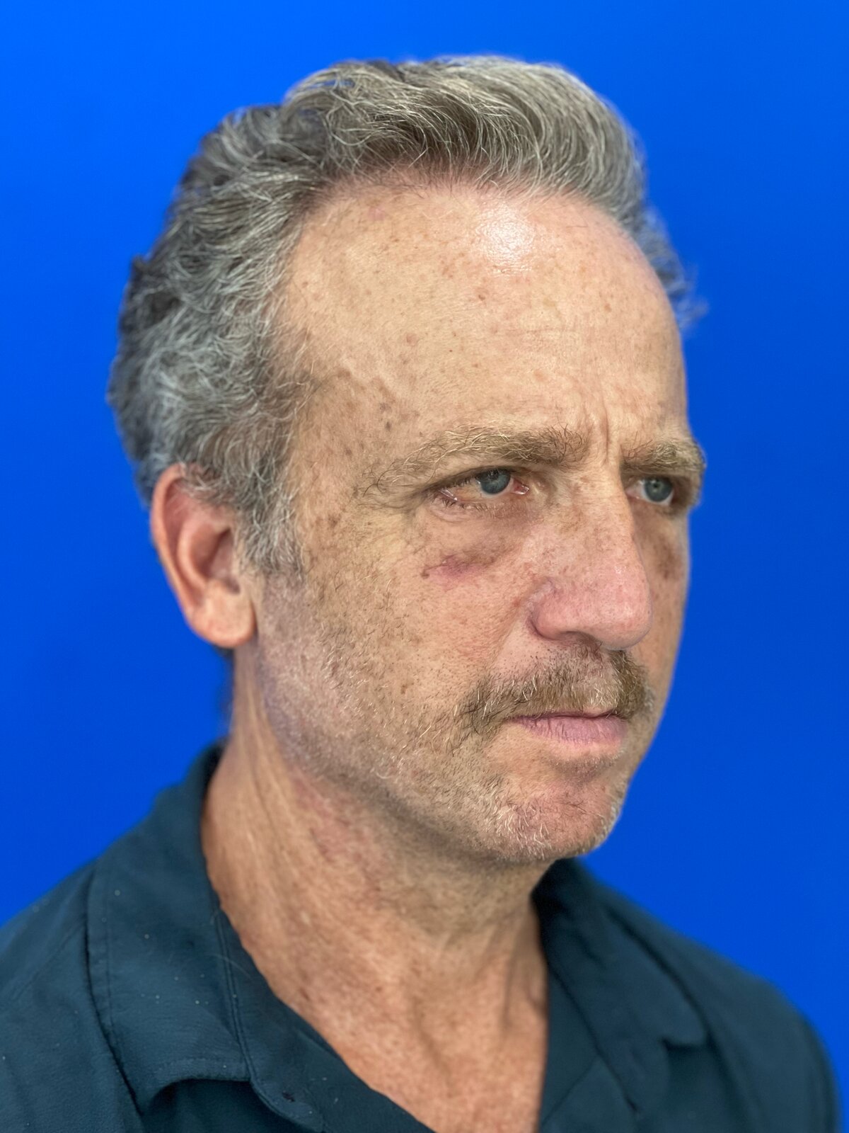 Male Upper & Lower Blepharoplasty in His 60s, before, view 2